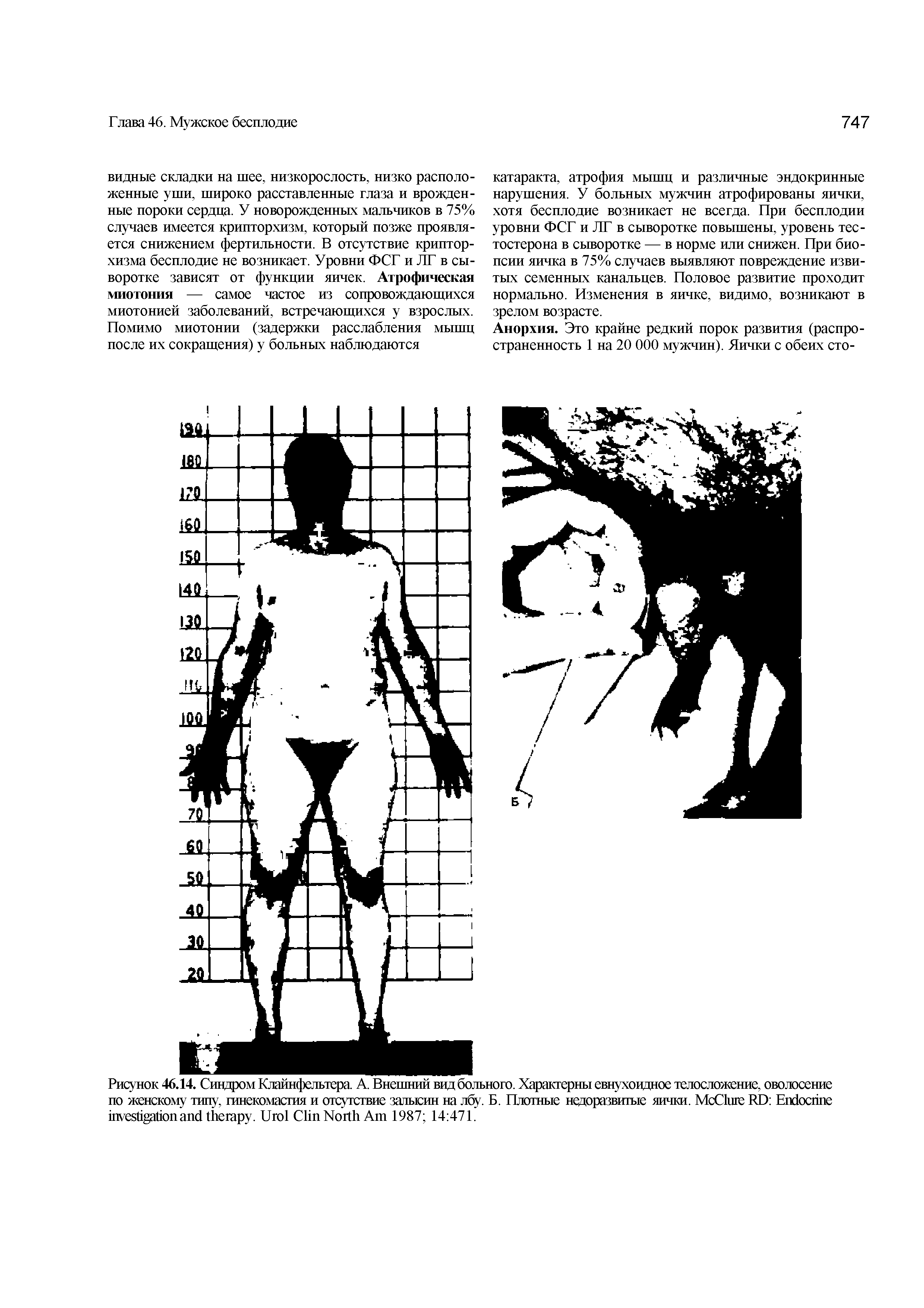 Рисунок 46.14. Синдром Клайнфельтера. А. Внешний вид больного. Характерны евнухоидное телосложение, оволосение по женскому типу, гинекомастия и отсутствие залысин на лбу. Б. Плотные недоразвитые яички. M C RD E . U C N A 1987 14 471.