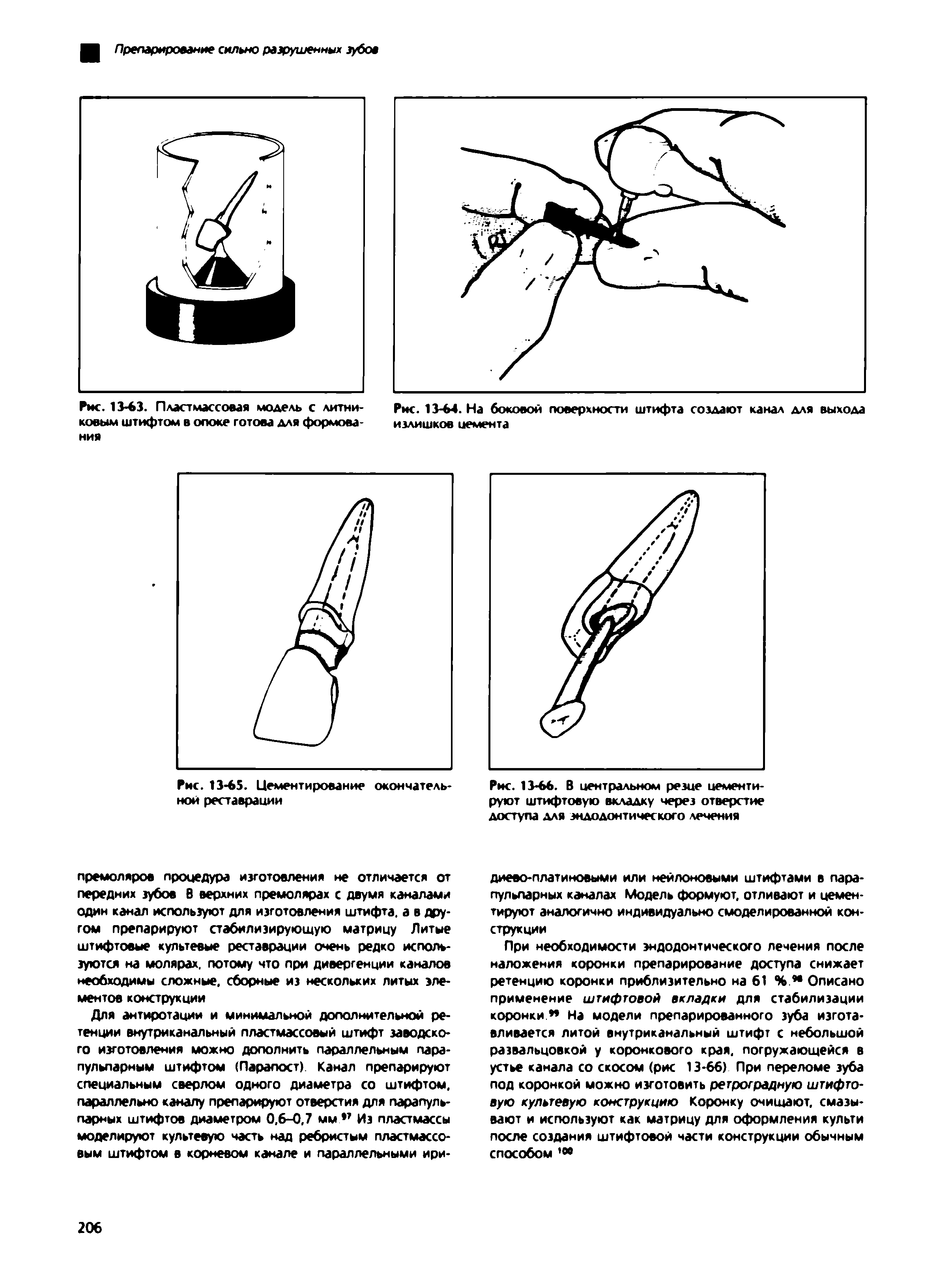 Рис. 13-66. В центральном резце цементируют штифтовую вкладку через отверстие доступа для эндодонтического лечения...