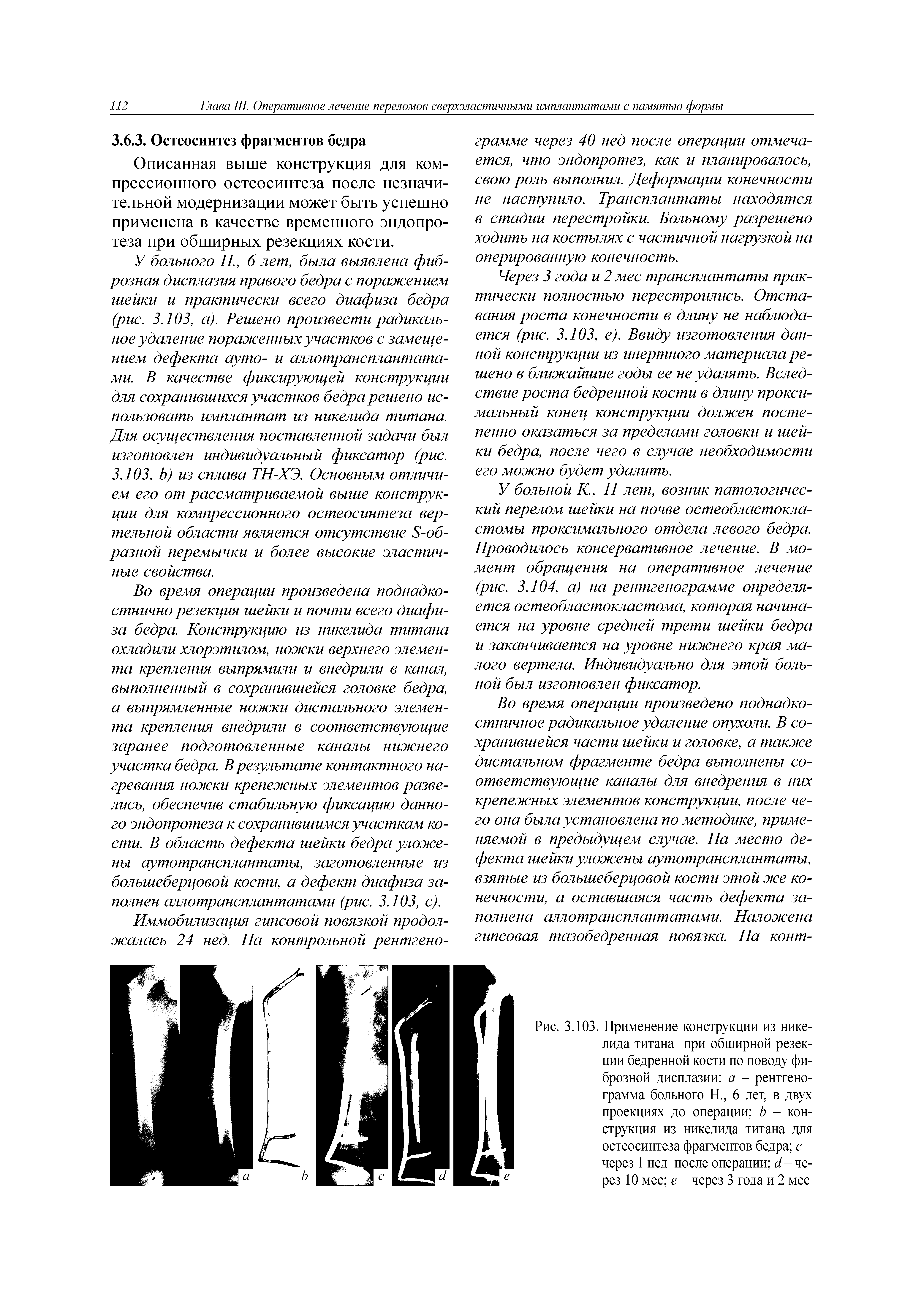 Рис. 3.103. Применение конструкции из никелида титана при обширной резекции бедренной кости по поводу фиброзной дисплазии а - рентгенограмма больного Н., 6 лет, в двух проекциях до операции Ь - конструкция из никелида титана для остеосинтеза фрагментов бедра с -через 1 нед после операции б/-через 10 мес е - через 3 года и 2 мес...