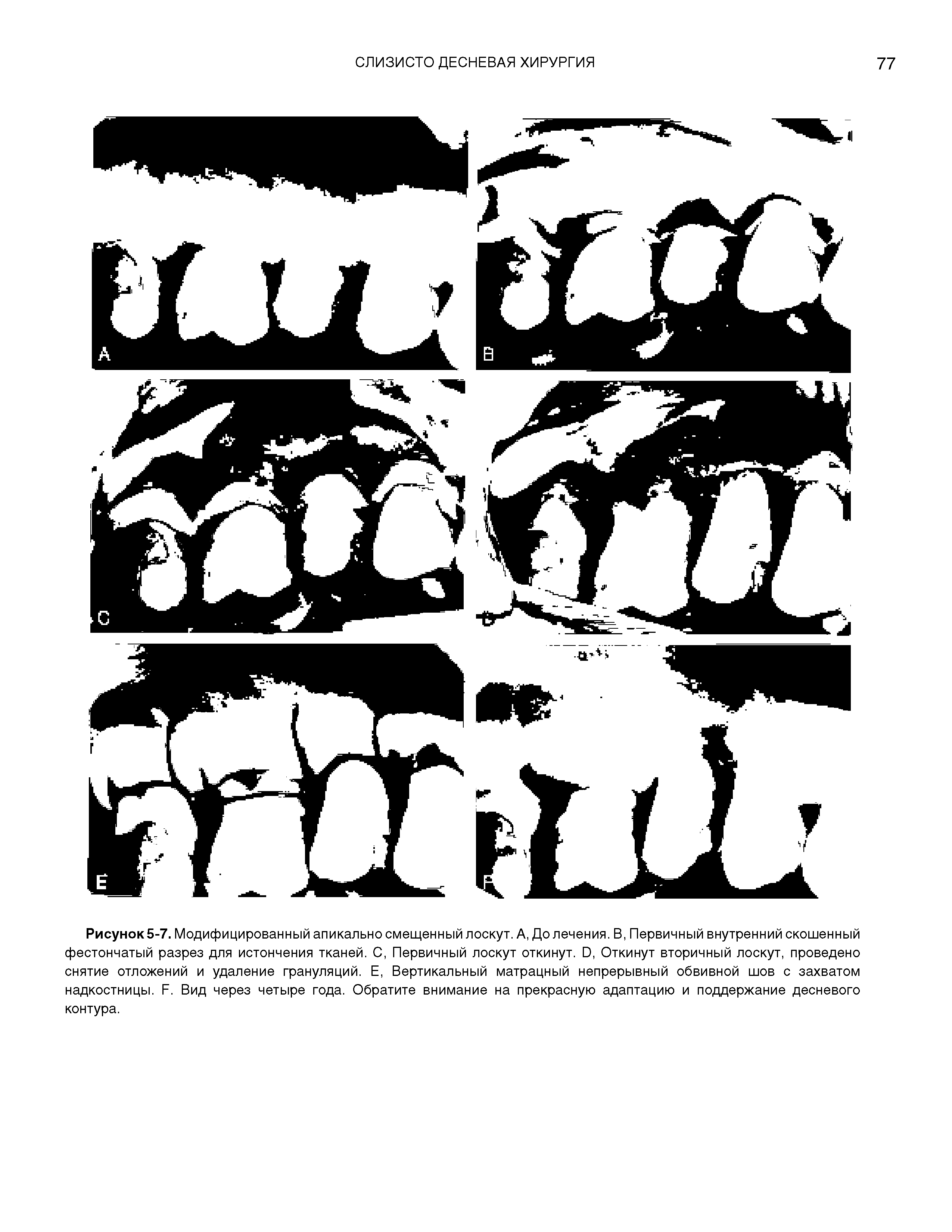 Рисунок 5-7. Модифицированный апикально смещенный лоскут. А, До лечения. В, Первичный внутренний скошенный фестончатый разрез для истончения тканей. С, Первичный лоскут откинут. О, Откинут вторичный лоскут, проведено снятие отложений и удаление грануляций. Е, Вертикальный матрацный непрерывный обвивной шов с захватом надкостницы. Л. Вид через четыре года. Обратите внимание на прекрасную адаптацию и поддержание десневого контура.