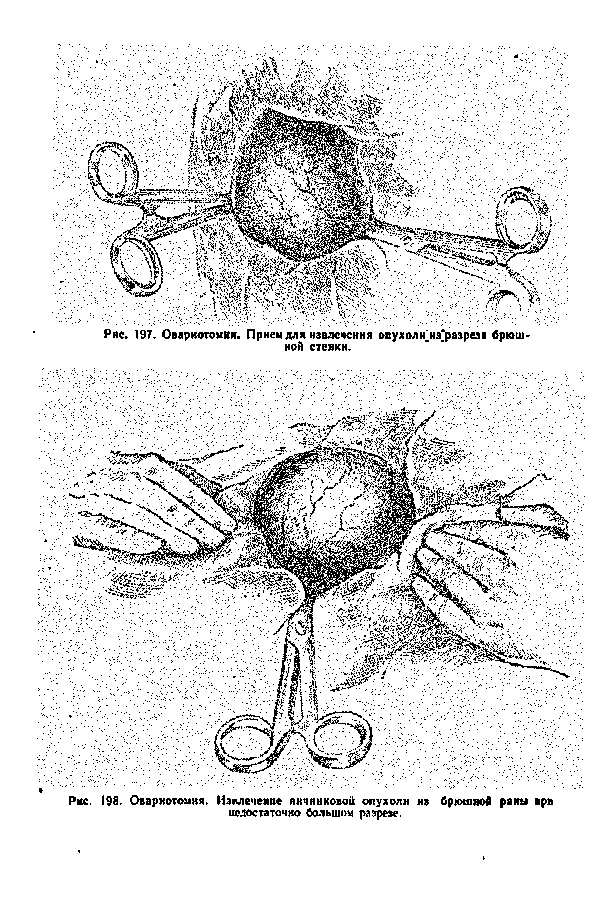 Рис. 198. Овариотомия. Извлечение яичниковой опухоли из брюшной раны при недостаточно большом разрезе.
