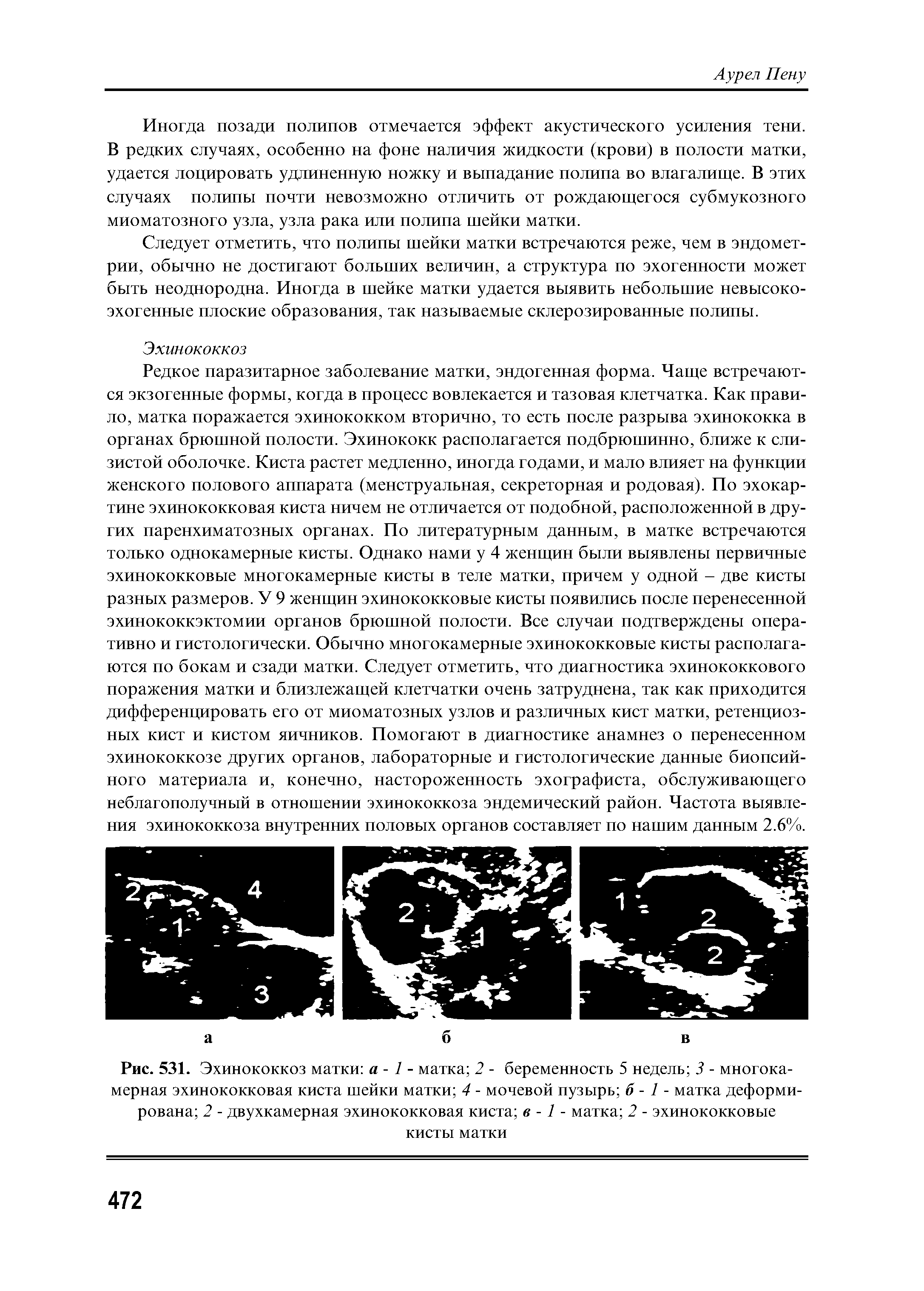 Рис. 531. Эхинококкоз матки а - 1 - матка 2 - беременность 5 недель 3 - многокамерная эхинококковая киста шейки матки 4 - мочевой пузырь б - 1 - матка деформирована 2 - двухкамерная эхинококковая киста в -1 - матка 2 - эхинококковые кисты матки...