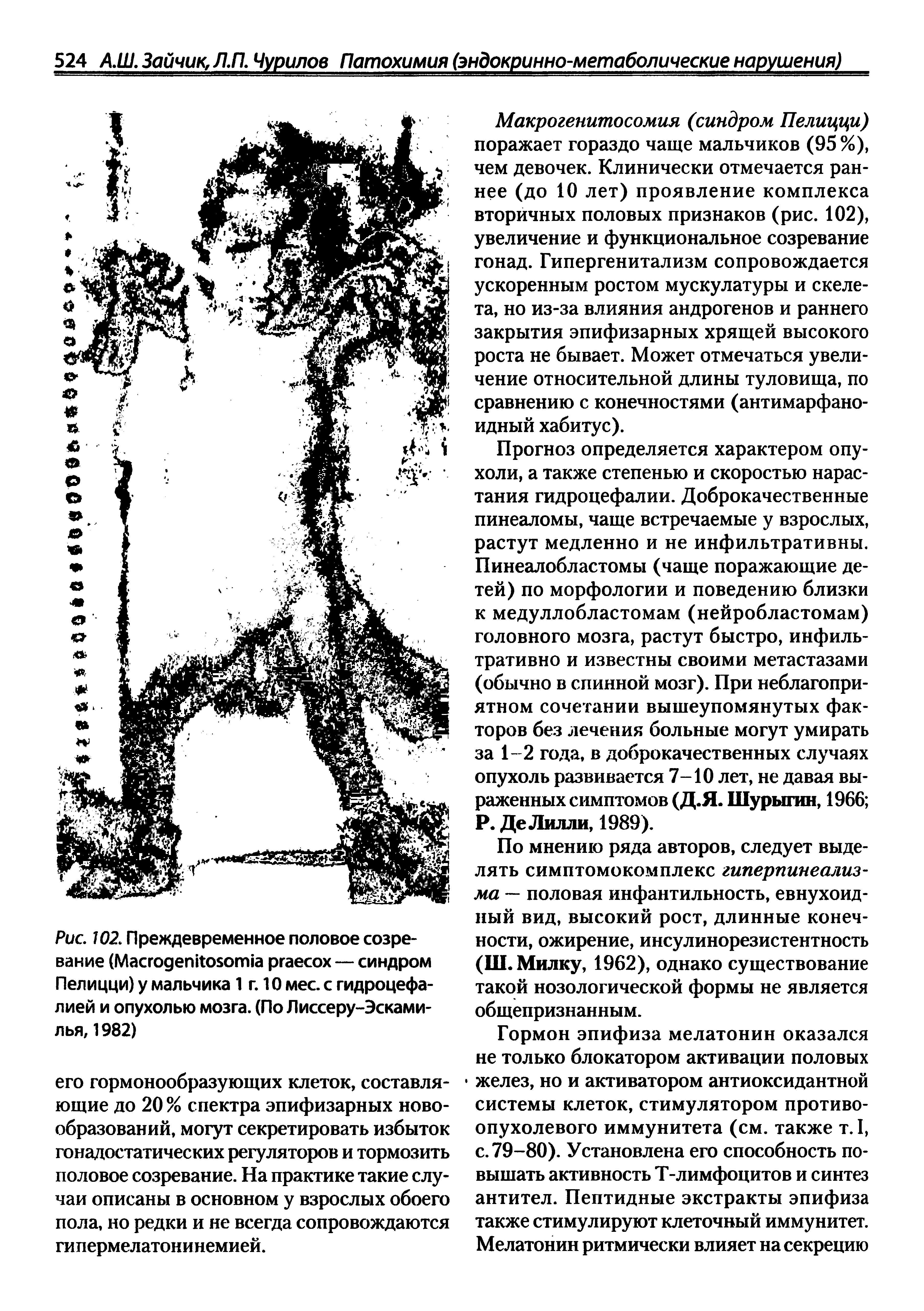 Рис. 102. Преждевременное половое созревание (M ргаесох — синдром Пелицци) у мальчика 1 г. 10 мес. с гидроцефалией и опухолью мозга. (По Лиссеру-Эсками-лья, 1982)...