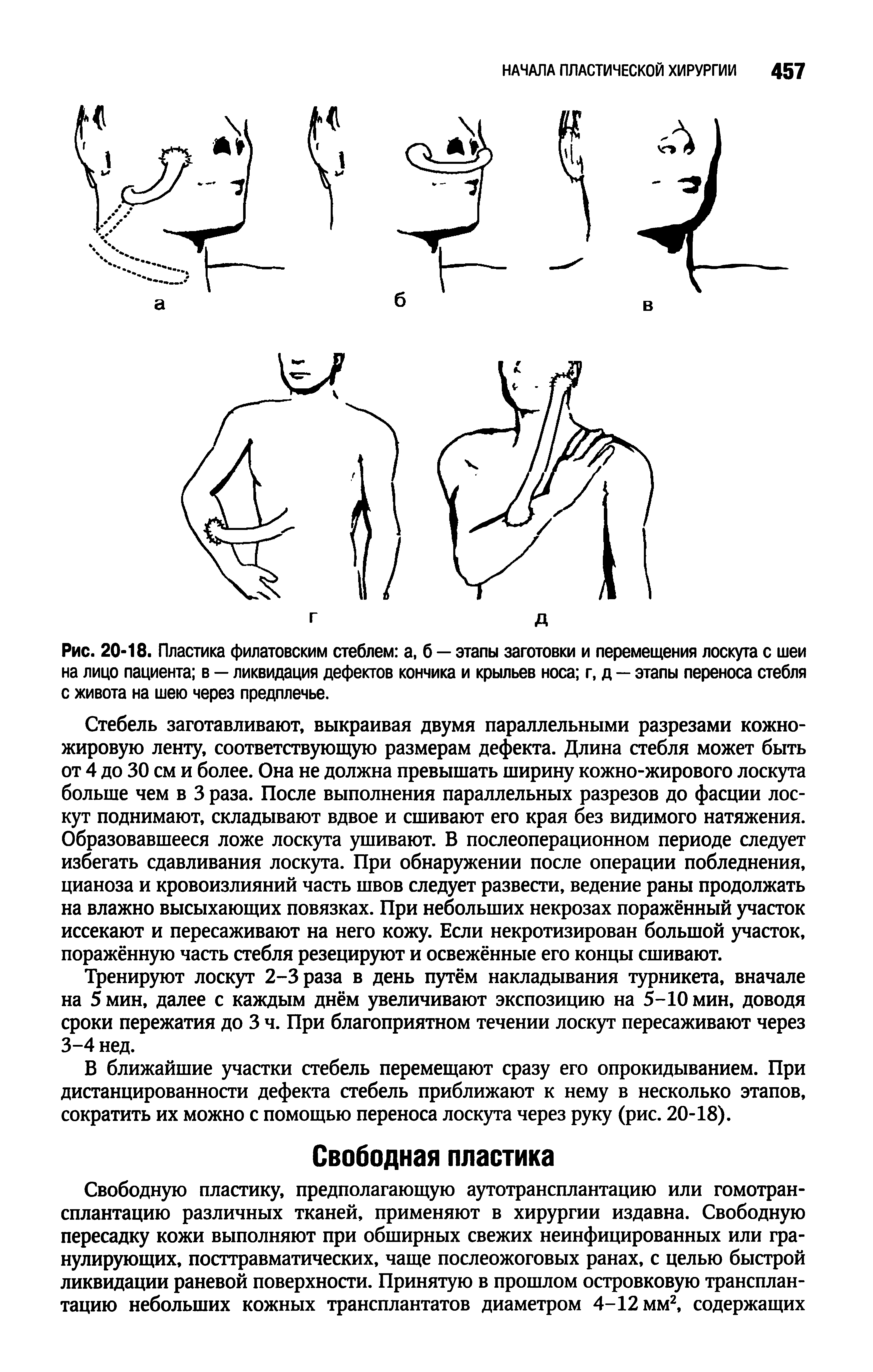 Рис. 20-18. Пластика филатовским стеблем а, б — этапы заготовки и перемещения лоскута с шеи на лицо пациента в — ликвидация дефектов кончика и крыльев носа г, д — этапы переноса стебля с живота на шею через предплечье.