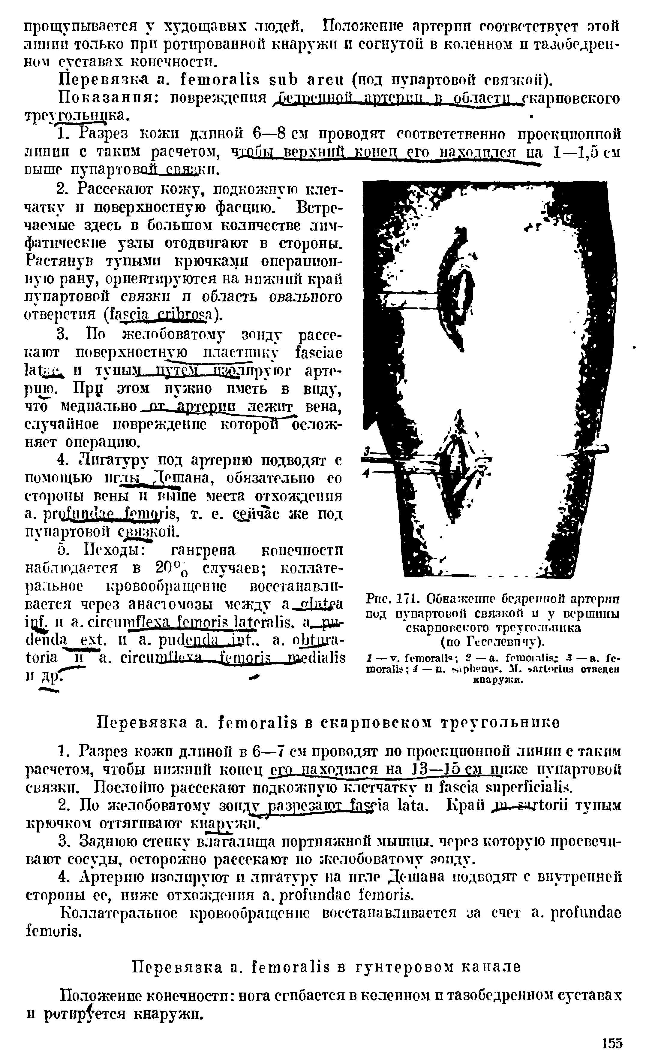 Рис. 171. Обнажение бедренной артерпп под пупартоной связкой п у вершины скарповского треугольника (по Ге се лови чу).