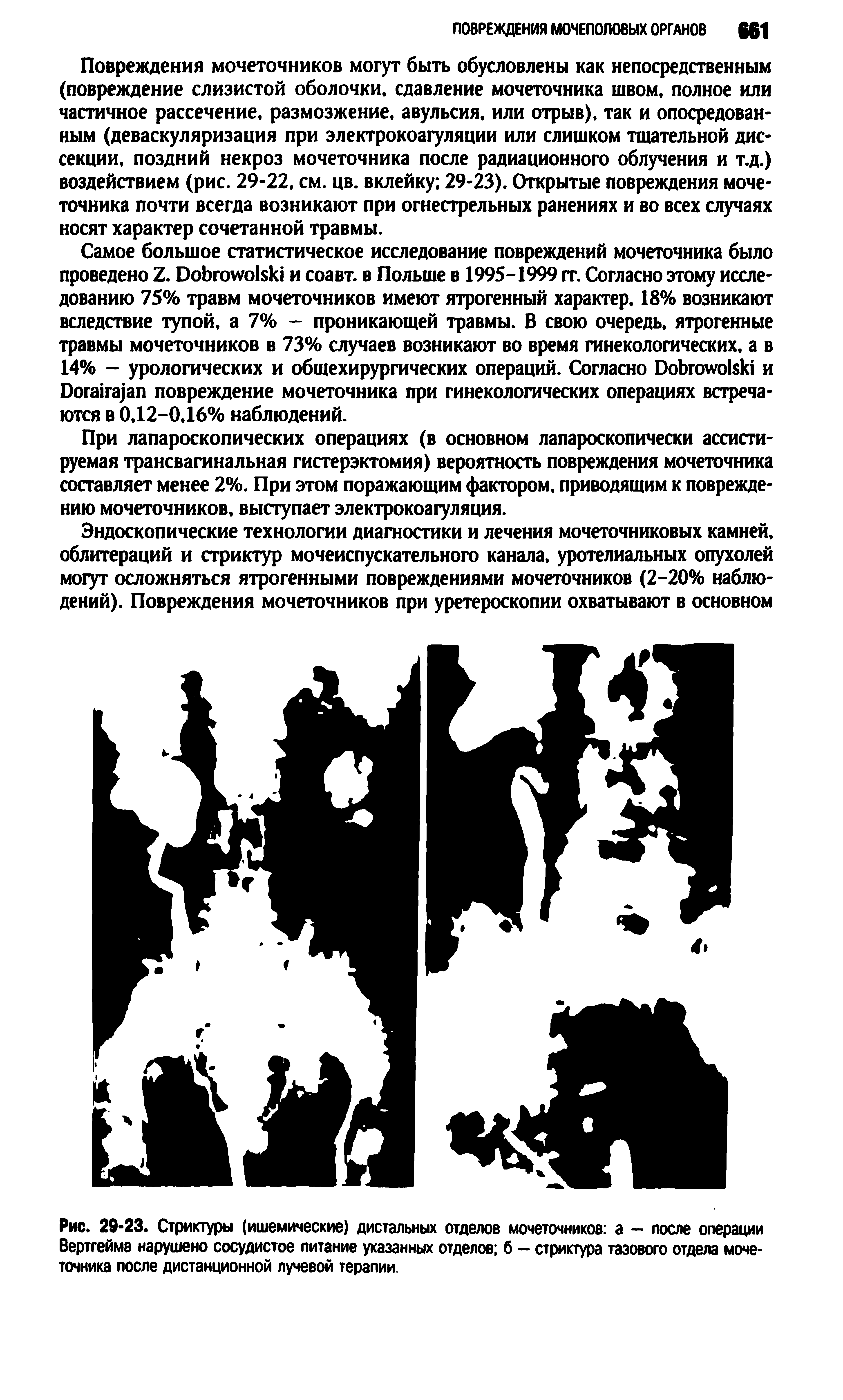 Рис. 29-23. Стриктуры (ишемические) дистальных отделов мочеточников а — после операции Вертгейма нарушено сосудистое питание указанных отделов б — стриктура тазового отдела мочеточника после дистанционной лучевой терапии...