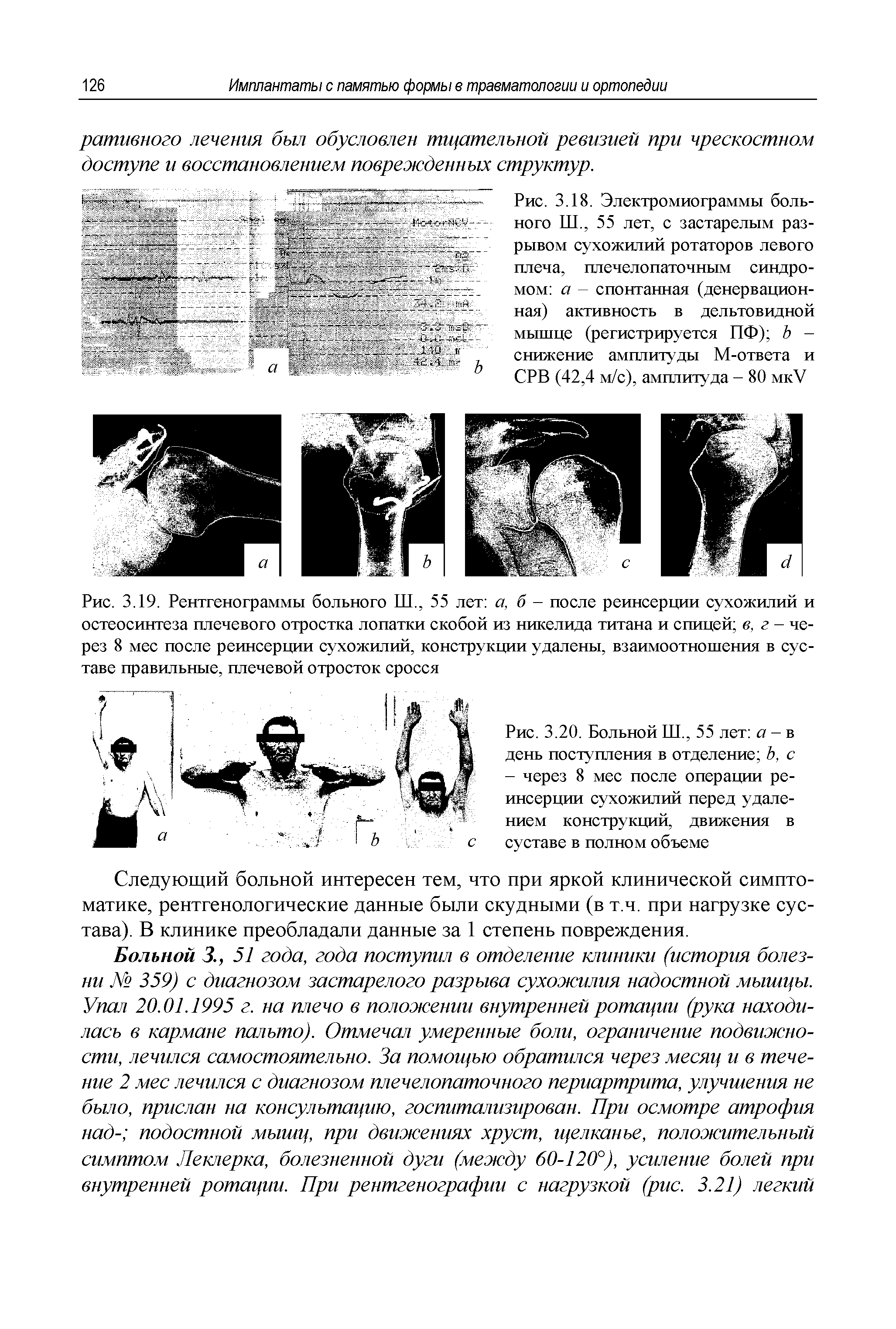 Рис. 3.19. Рентгенограммы больного Ш., 55 лет а, б - после реинсерции сухожилий и остеосинтеза плечевого отростка лопатки скобой из никелида титана и спицей в, г - через 8 мес после реинсерции сухожилий, конструкции удалены, взаимоотношения в суставе правильные, плечевой отросток сросся...