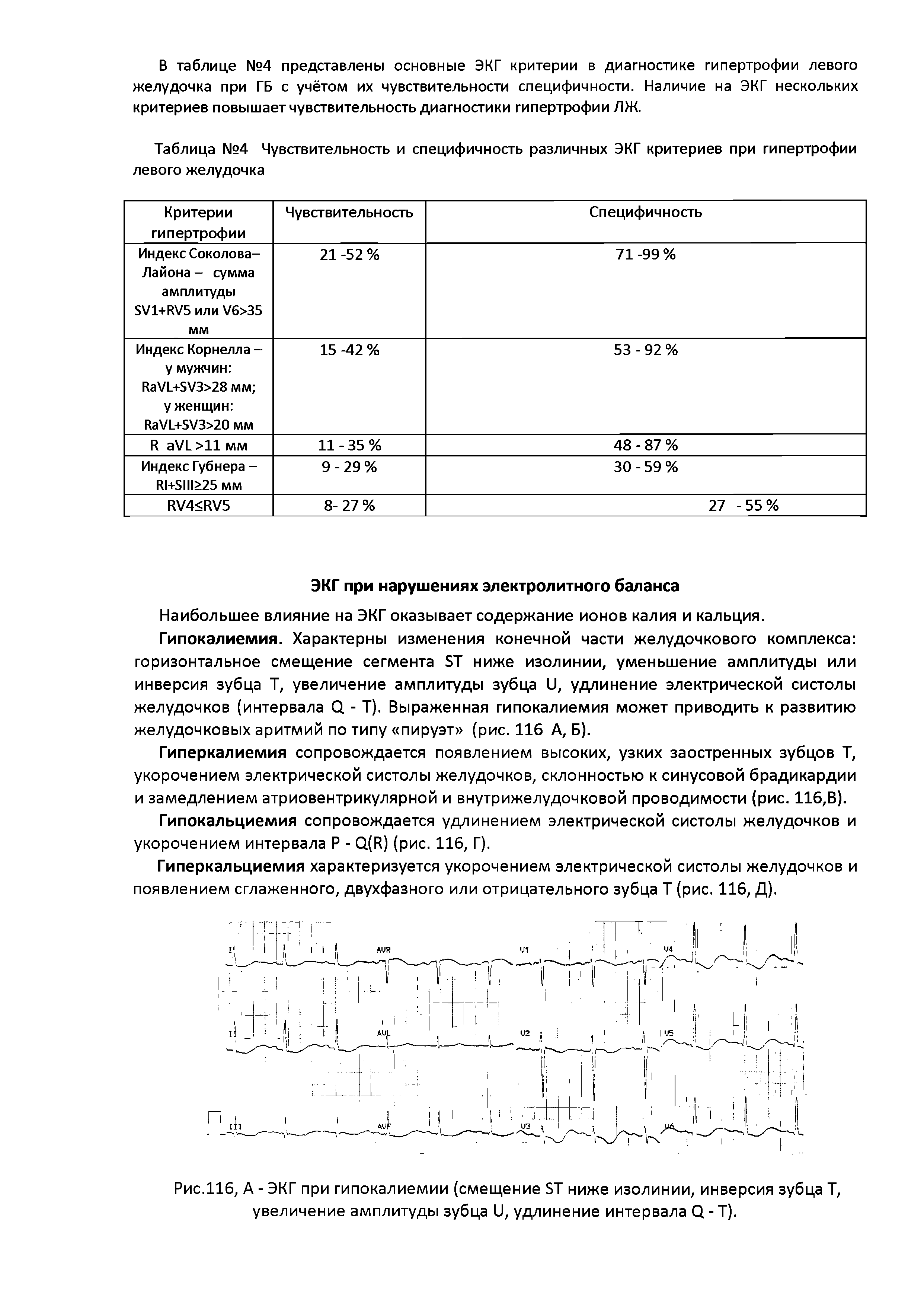 Рис.116, А - ЭКГ при гипокалиемии (смещение БТ ниже изолинии, инверсия зубца Т, увеличение амплитуды зубца II, удлинение интервала О - Т).