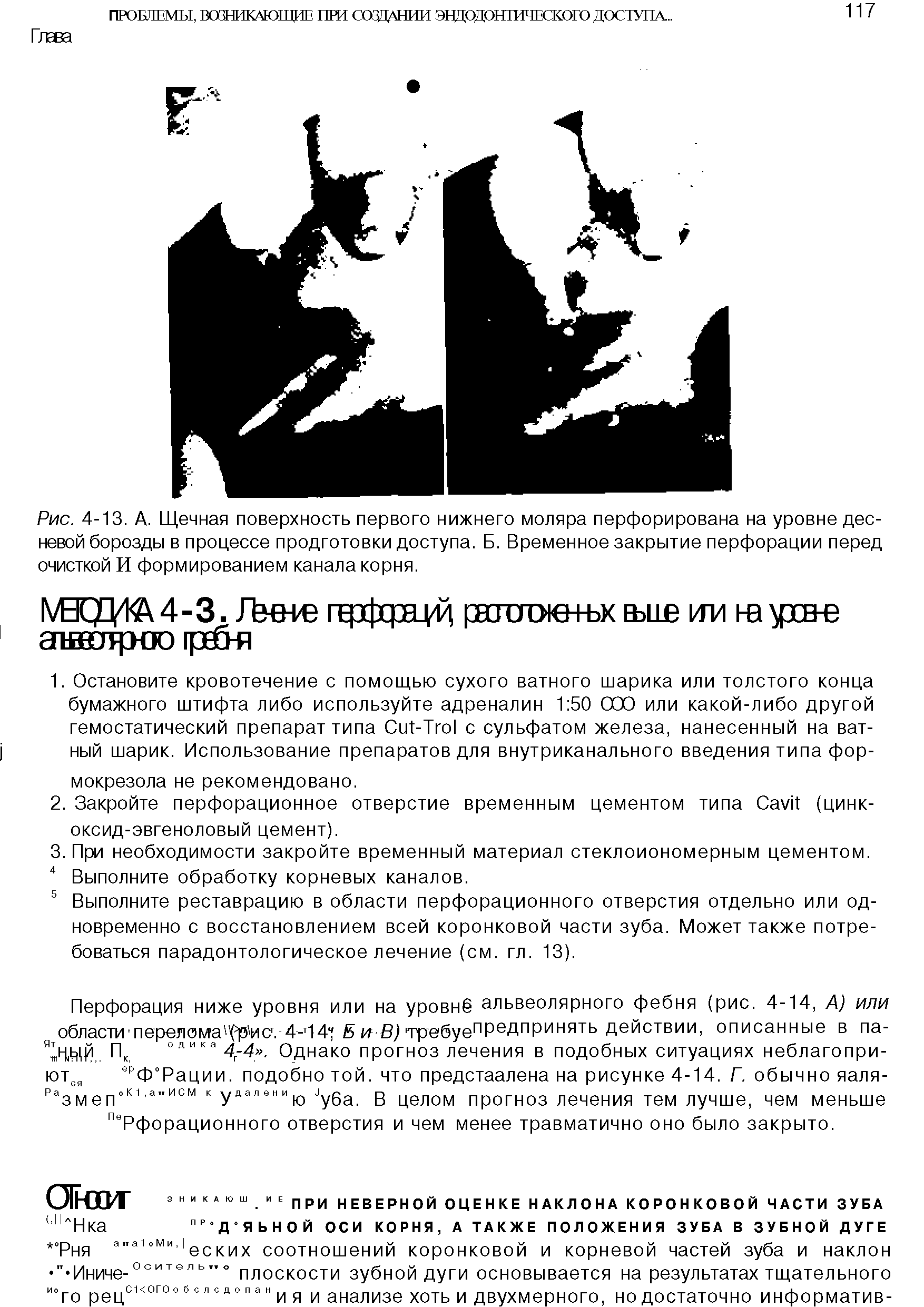 Рис. 4-13. А. Щечная поверхность первого нижнего моляра перфорирована на уровне десневой борозды в процессе продготовки доступа. Б. Временное закрытие перфорации перед очисткой И формированием канала корня.