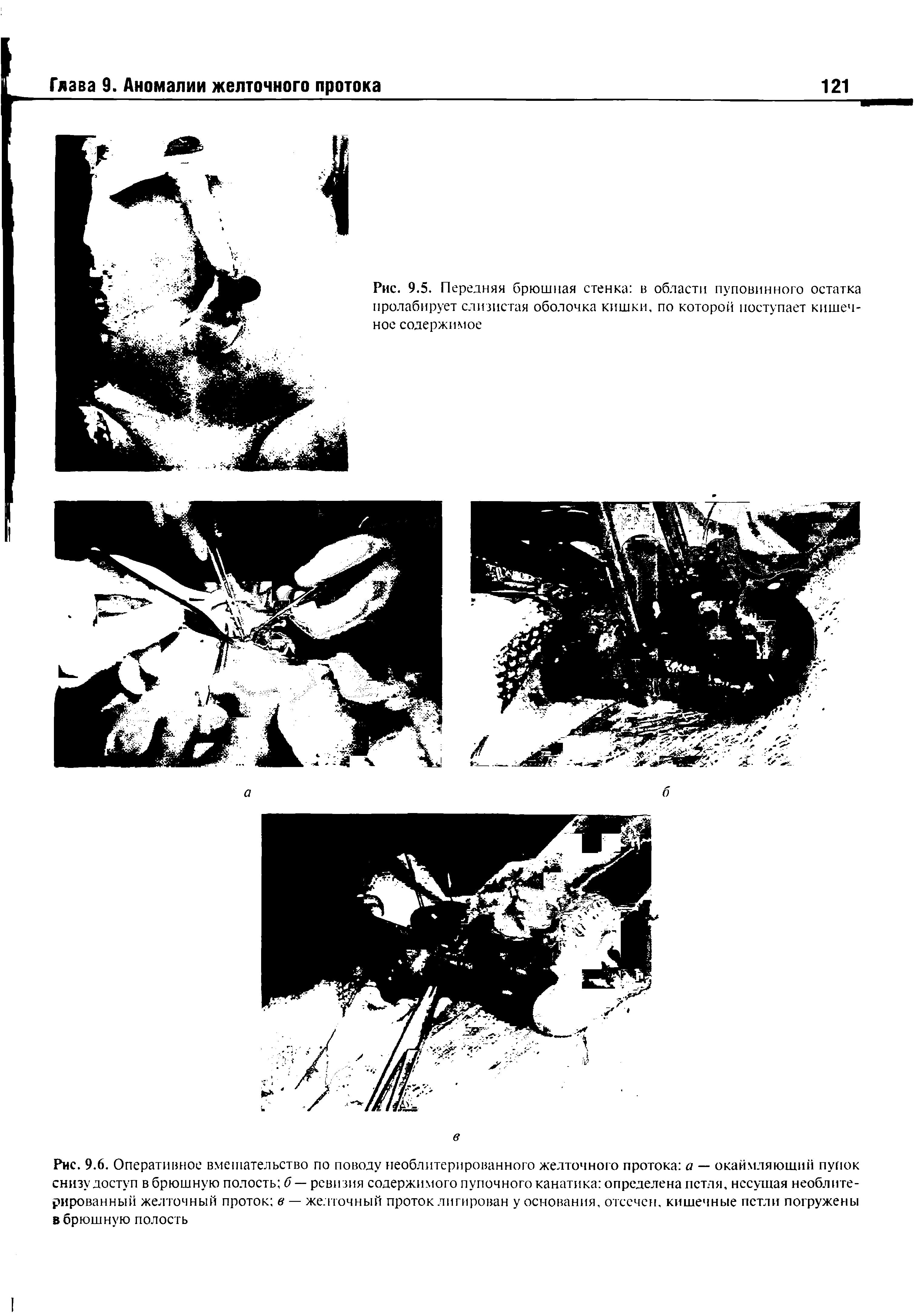 Рис. 9.6. Оперативное вмешательство по поводу необлитерированного желточного протока а — окаймляющий пупок снизу доступ в брюшную полость б— ревизия содержимого пупочного канатика определена петля, несущая необлиге-рированный желточный проток в — желточный проток лигирован у основания, отсечен, кишечные петли погружены в брюшную полость...