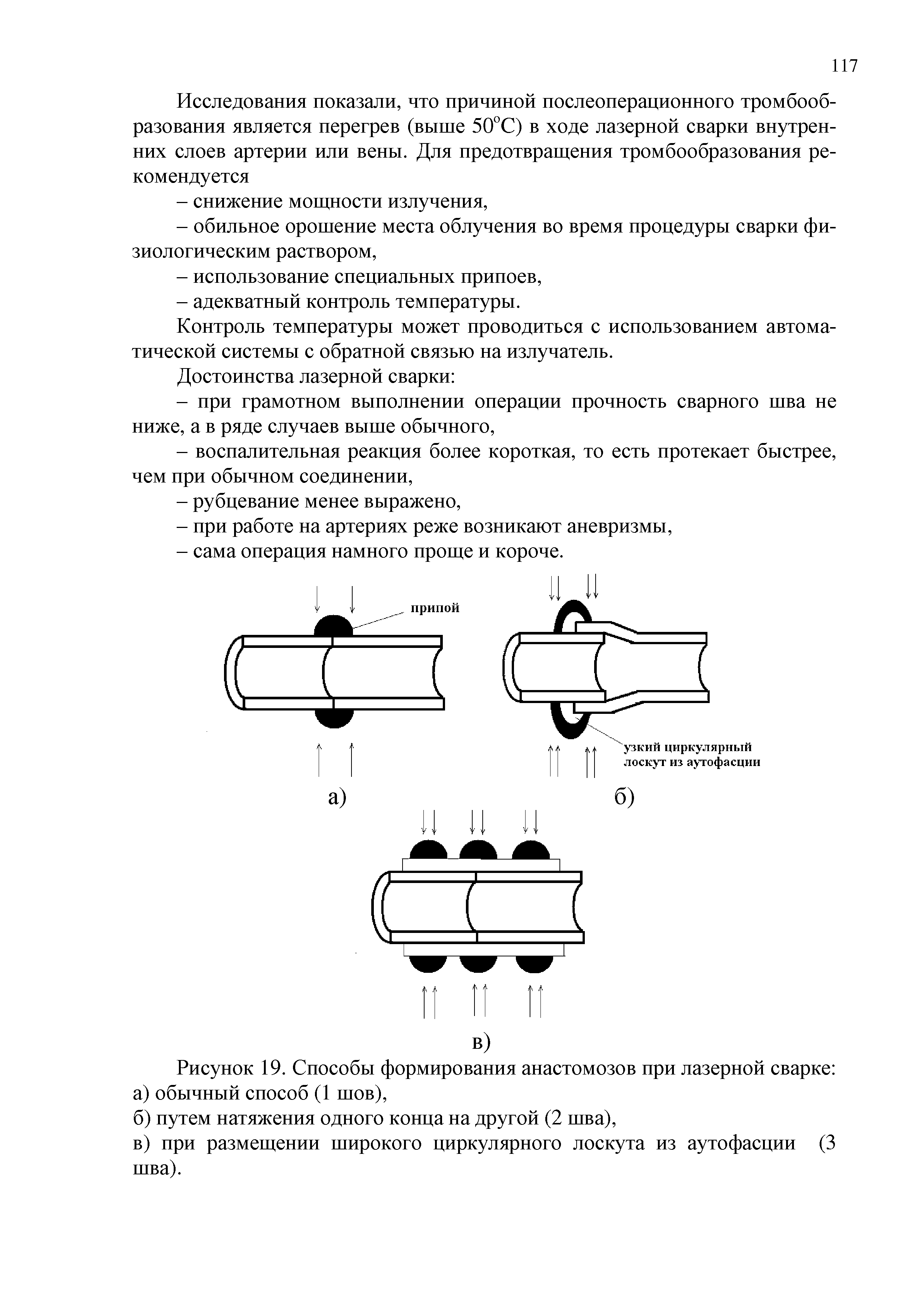 Рисунок 19. Способы формирования анастомозов при лазерной сварке ...