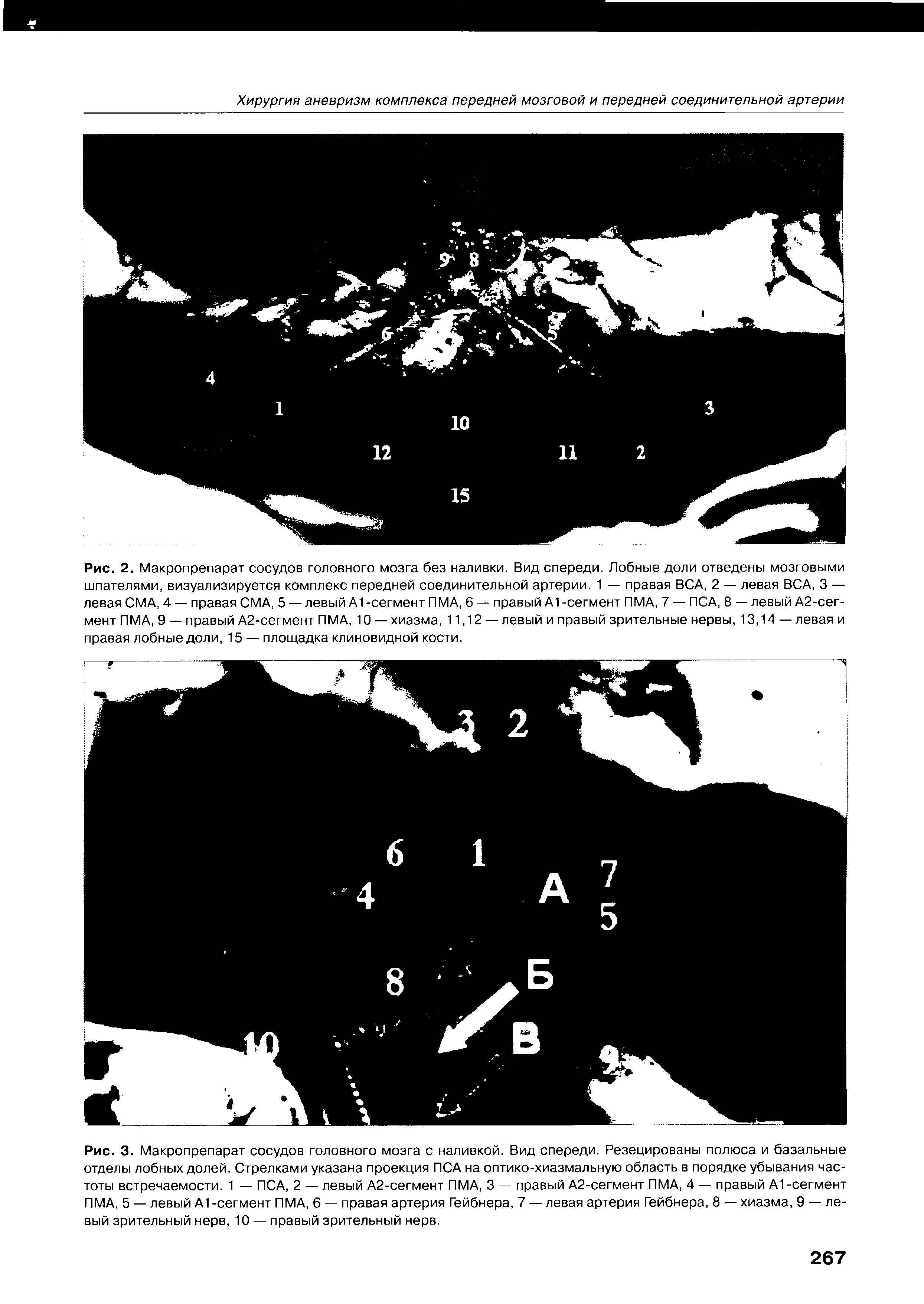 Рис. 3. Макропрепарат сосудов головного мозга с наливкой. Вид спереди. Резецированы полюса и базальные отделы лобных долей. Стрелками указана проекция ПСА на оптико-хиазмальную область в порядке убывания частоты встречаемости. 1 — ПСА, 2 — левый А2-сегмент ПМА, 3 — правый А2-сегмент ПМА, 4 — правый А1-сегмент ПМА, 5 — левый А1 -сегмент ПМА, 6 — правая артерия Гейбнера, 7 — левая артерия Гейбнера, 8 — хиазма, 9 — левый зрительный нерв, 10 — правый зрительный нерв.