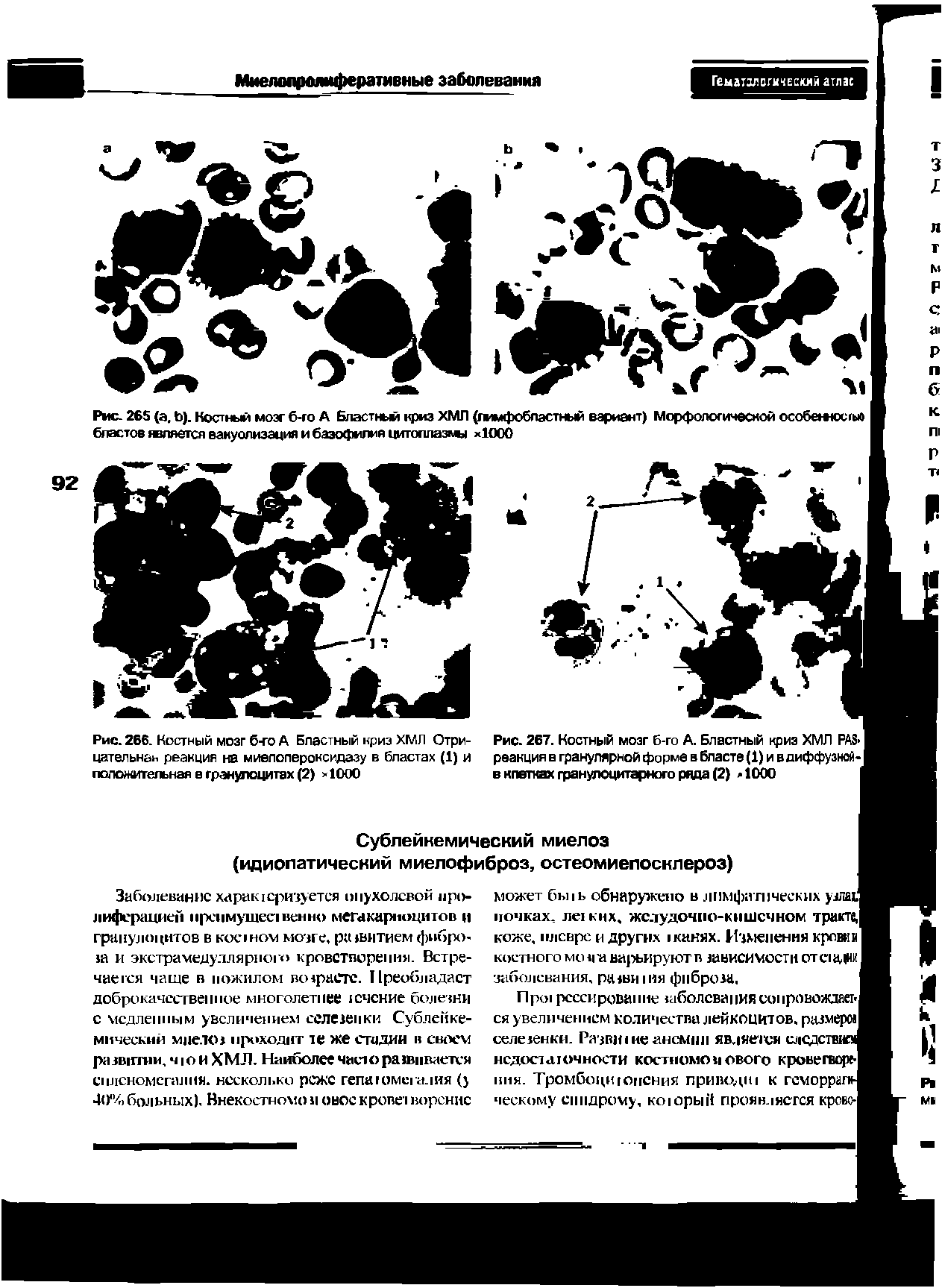 Рис. 267. Костный мозг б-го А. Бластный криз ХМЛ PAS-1 реакция в гранулярной форма в бласте (1) и в диффузной-] в клетках гранулоцитарного ряда (2) <1000 I...