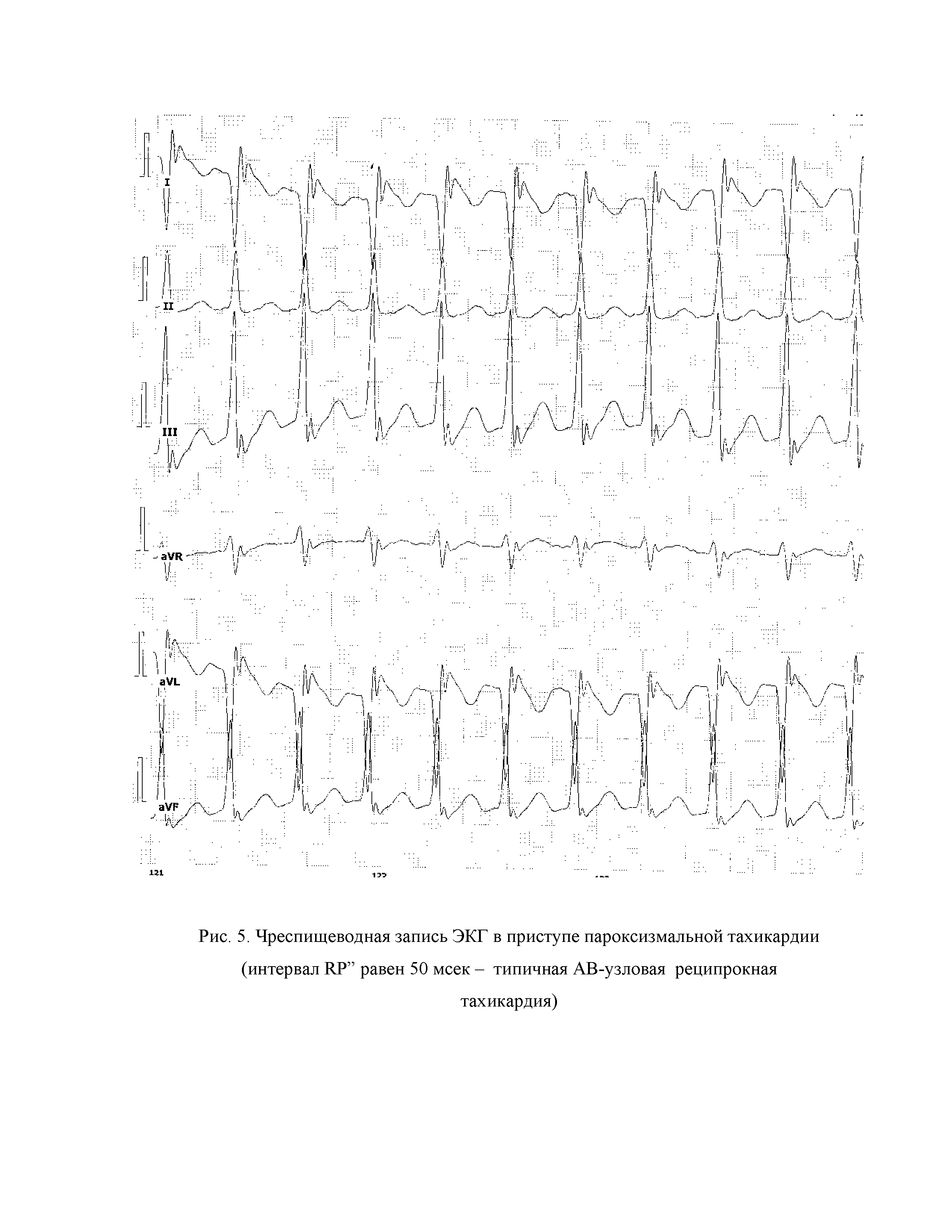 Рис. 5. Чреспищеводная запись ЭКГ в приступе пароксизмальной тахикардии (интервал ИР равен 50 мсек - типичная АВ-узловая реципрокная тахикардия)...