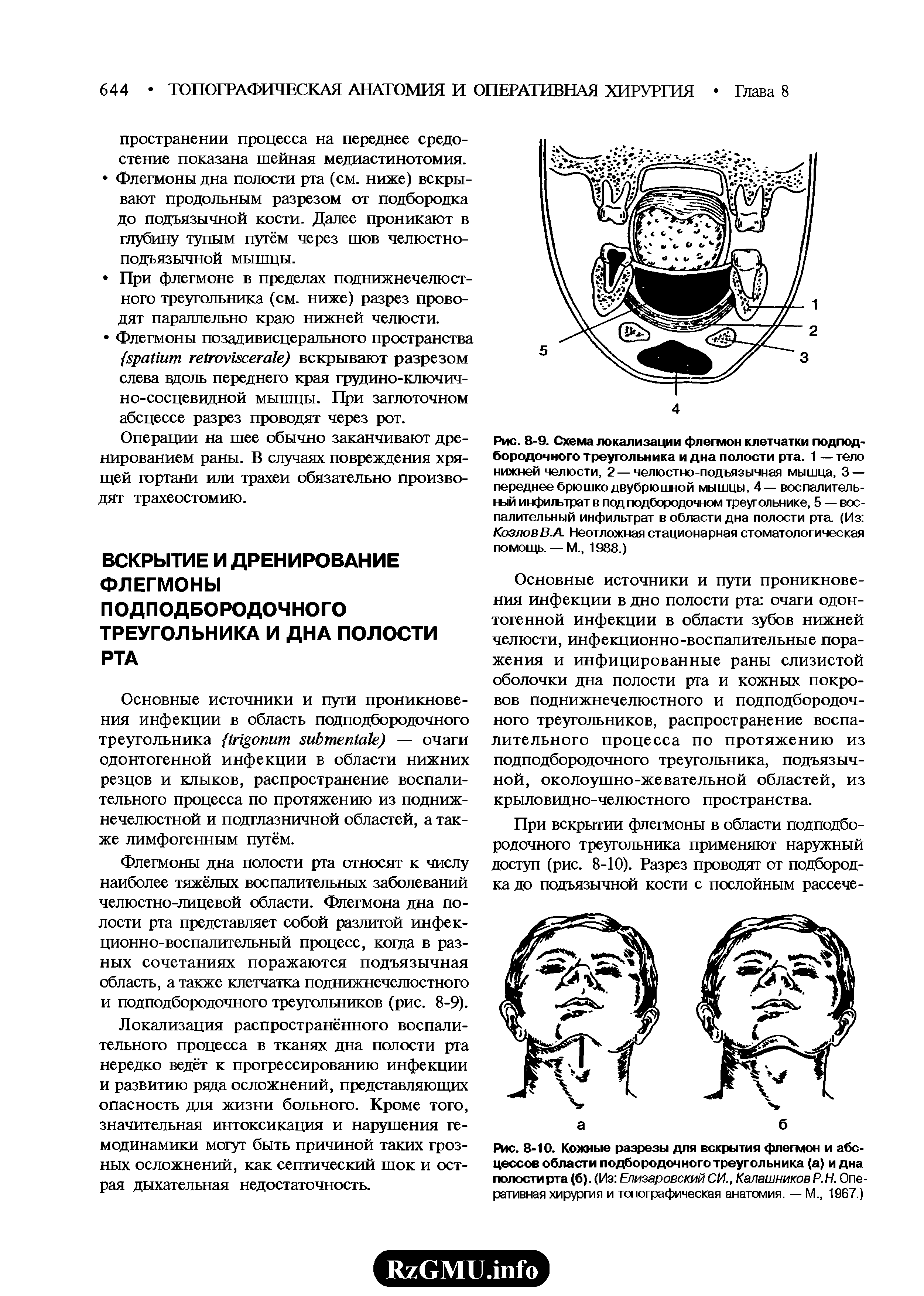 Рис. 8-9. Схема локализации флегмон клетчатки подподбородочного треугольника и дна полости рта. 1 —тело нижней челюсти, 2 — челюстно-подъязычная мышца, 3 — переднее брюшко двубрюшной мышцы, 4— воспалительный инфильтрат в под подбородочном треугольнике, 5 — воспалительный инфильтрат в области дна полости рта. (Из Козлов В.А. Неотложная стационарная стоматологическая помощь. — М., 1988.)...