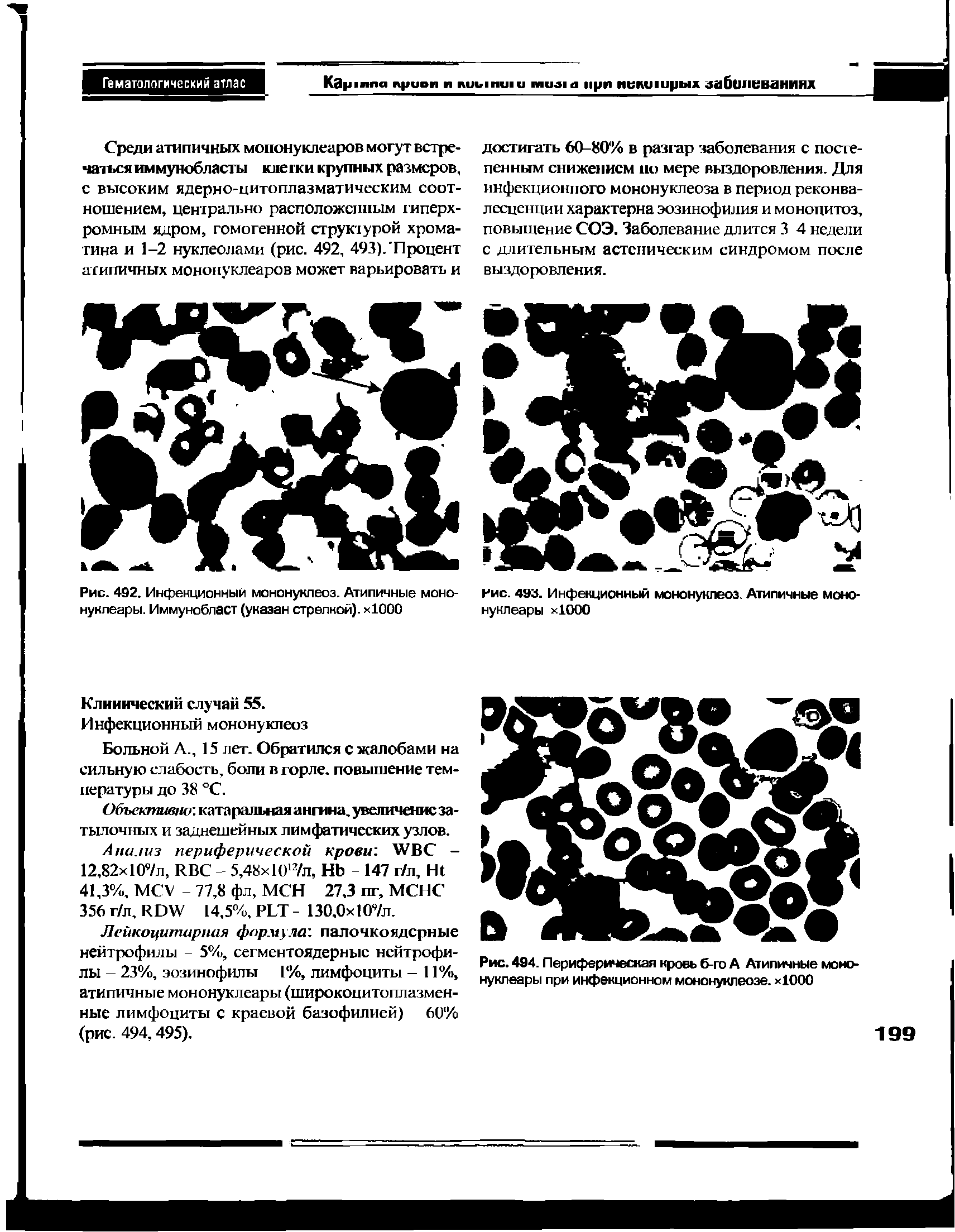 Рис. 494. Периферическая кровь б-го А Атипичные мононуклеары при инфекционном мононуклеозе. х1000...