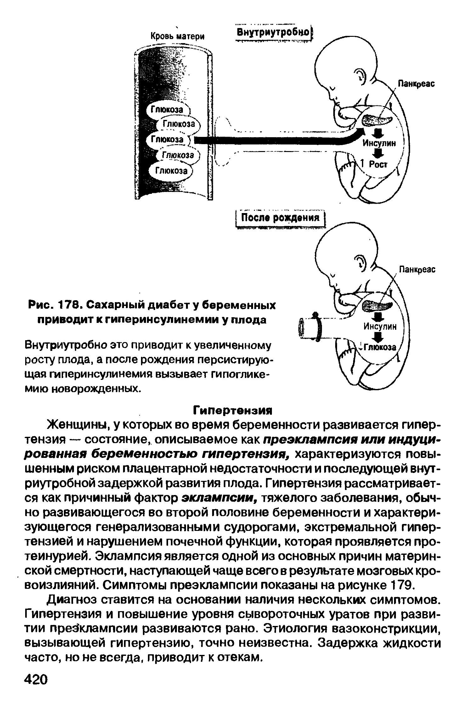 Рис. 178. Сахарный диабету беременных приводит к гиперинсулинемии у плода...