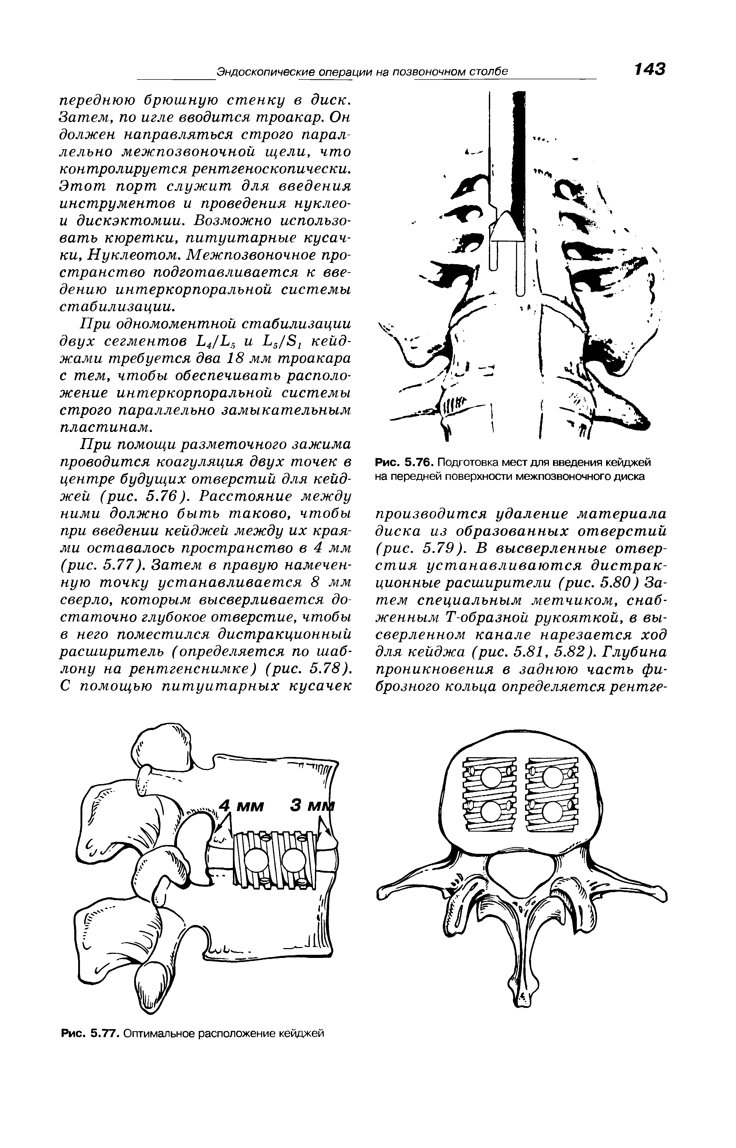 Рис. 5.76. Подготовка мест для введения кейджей на передней поверхности межпозвоночного диска...