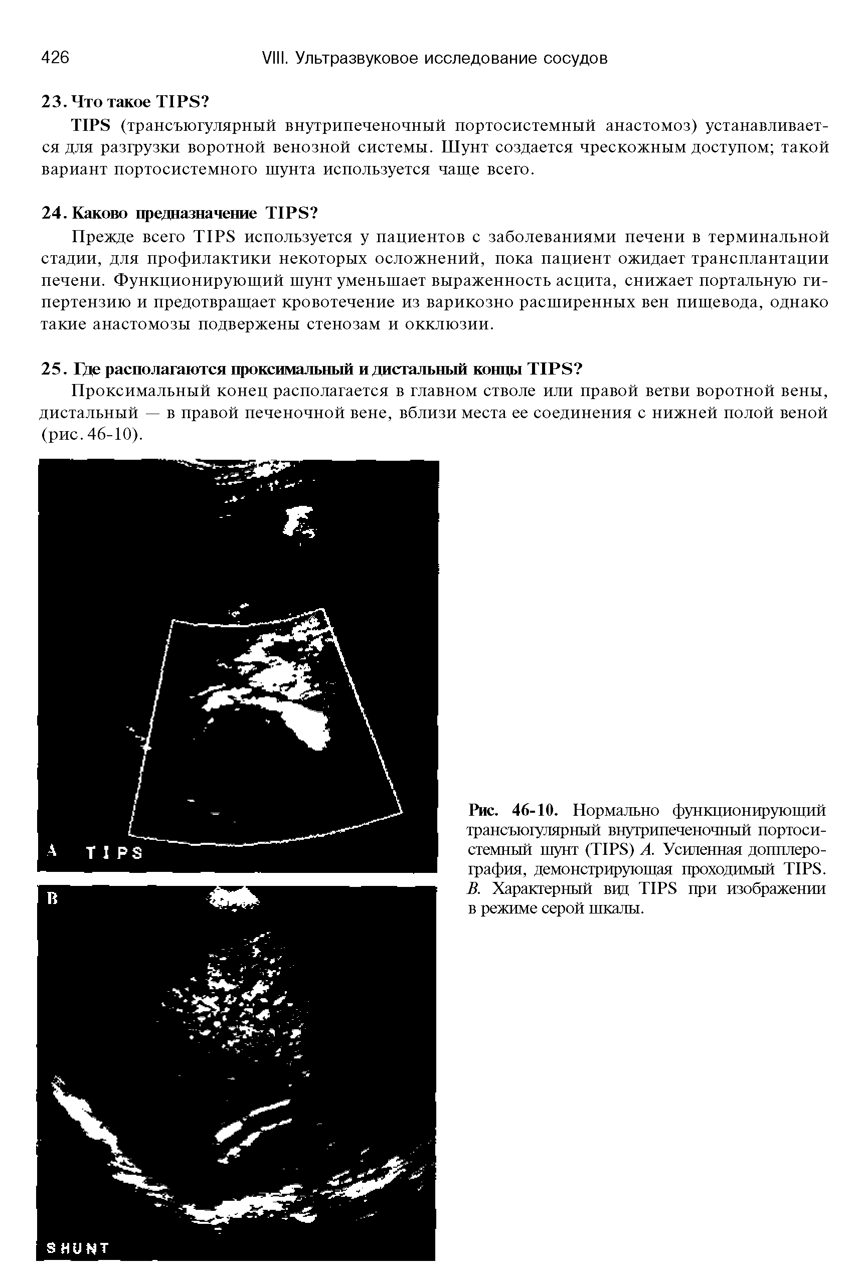 Рис. 46-10. Нормально функционирующий трансъюгулярный внутрипеченочный портосистемный шунт (TIPS) А. Усиленная допплерография, демонстрирующая проходимый TIPS. В. Характерный вцд TIPS при изображении в режиме серой шкалы.