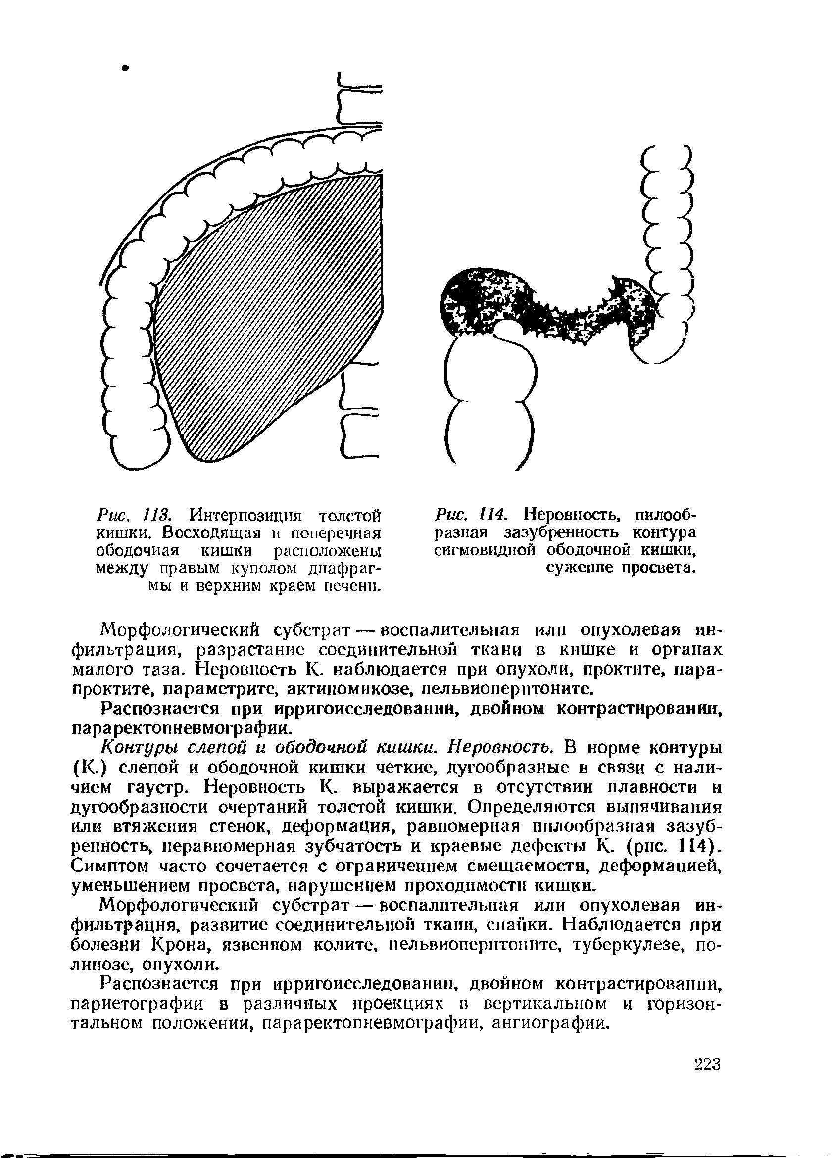 Рис. 113. Интерпозиция толстой кишки. Восходящая и поперечная ободочная кишки расположены между правым куполом диафрагмы и верхним краем печени.