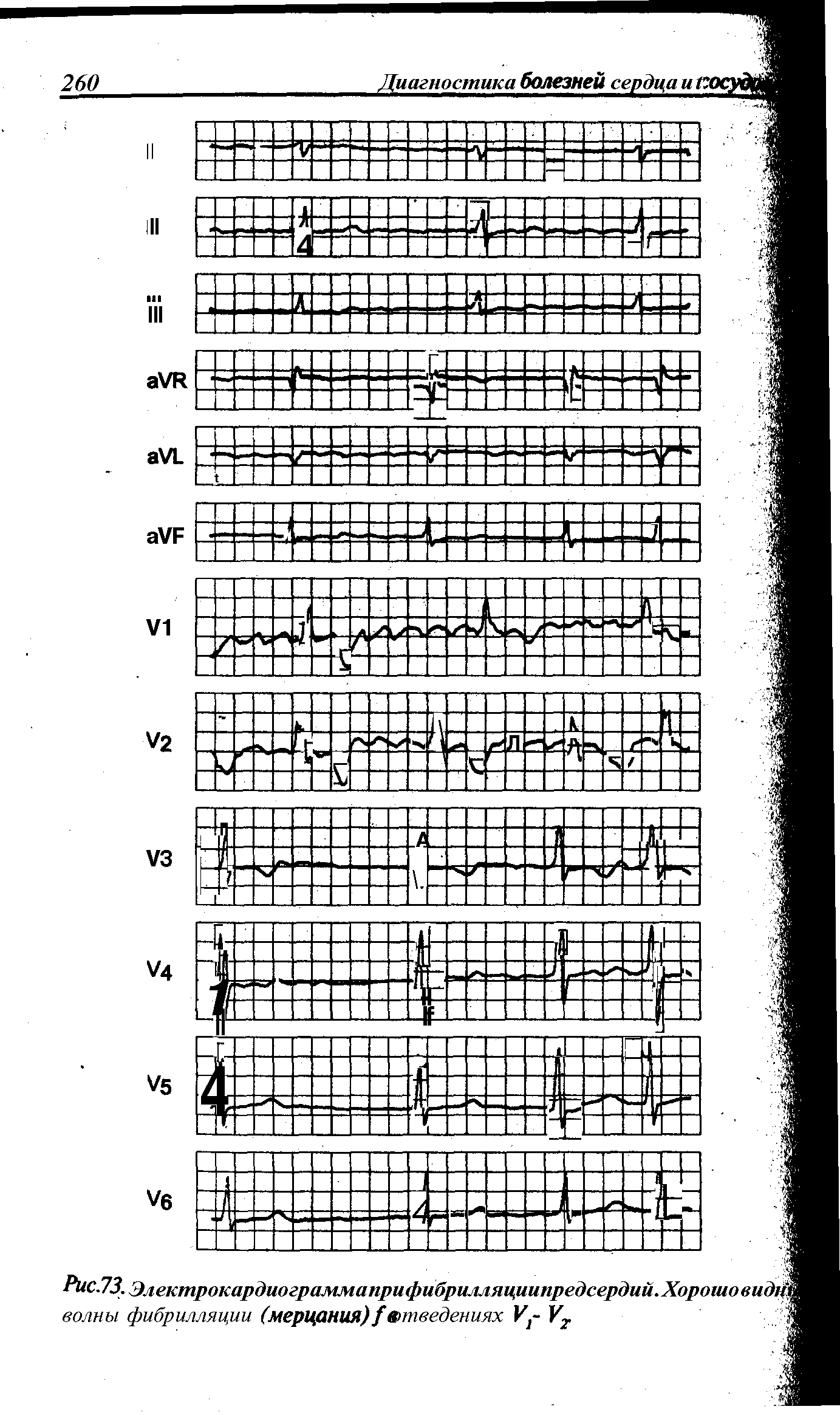 Рис.73. Электрокардиограммаприфибрилляи,1шпредсердий.Хорошовид волны фибрилляции (мерцания)/№тведениях И,- V ...