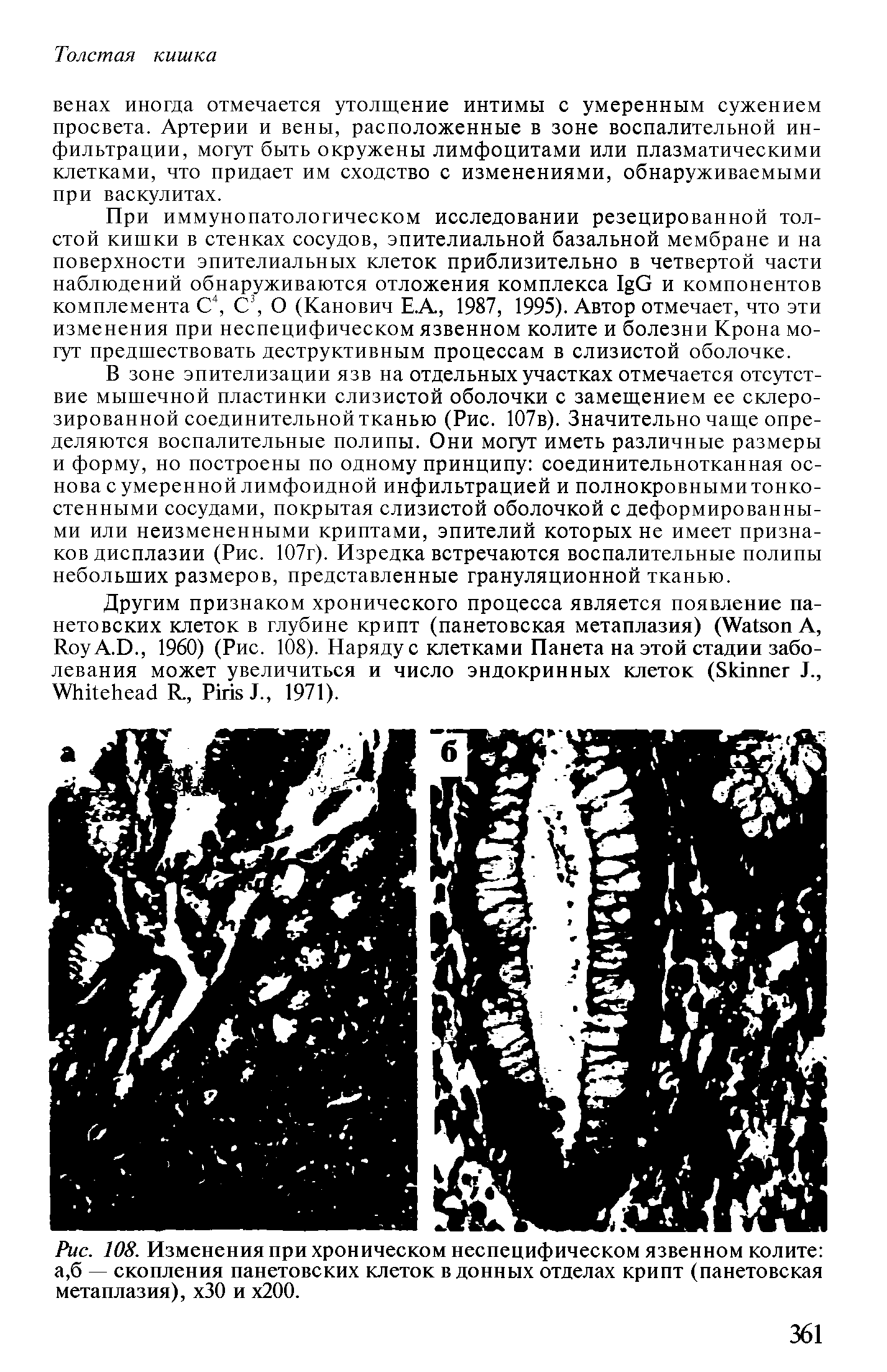 Рис. 108. Изменения при хроническом неспецифическом язвенном колите а,б — скопления панетовских клеток в донных отделах крипт (панетовская метаплазия), хЗО и х200.