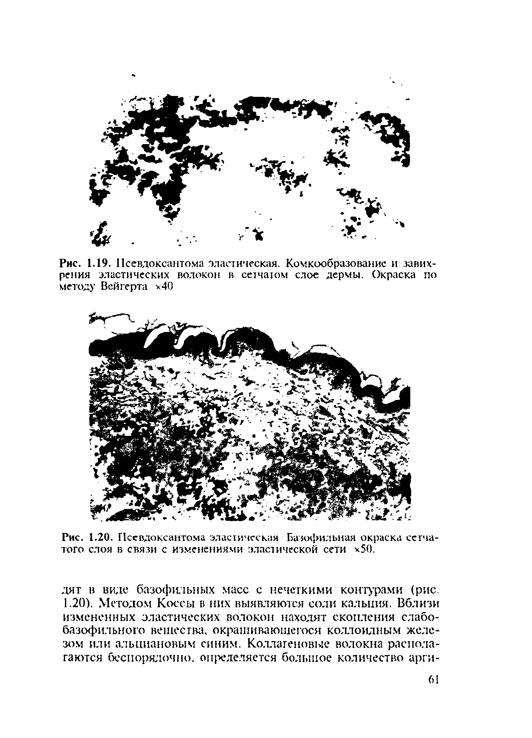 Рис. 1.20. Псевдоксанто.ма эластическая Базофильная окраска сетчатого слоя в связи с изменениями эластической сети 50.