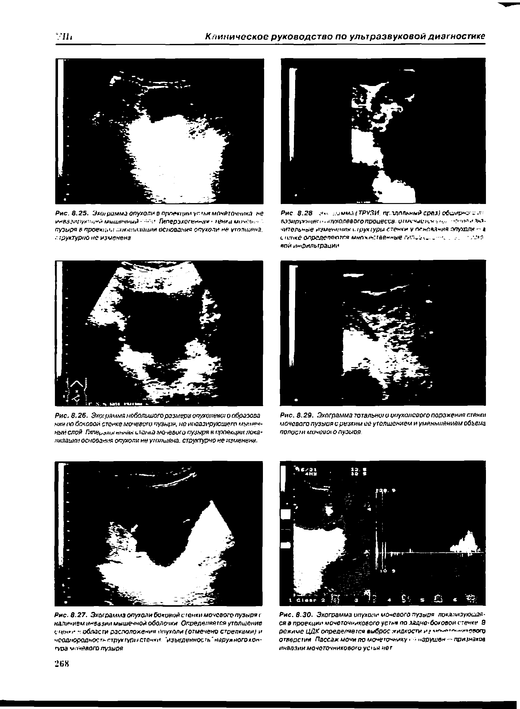 Рис. 8.27. Эхйсраммзопутолмб<зков1) с<енкимочевоюлузыр9( наличием инвазии мышечной оболочки Определяйте утолщение <гея >- области расположения опухоли (отмечено стрелками/ и неоднородности тяруктурнстенки. изьеденнрс ъ наружного лонгу мочевого луаыре...