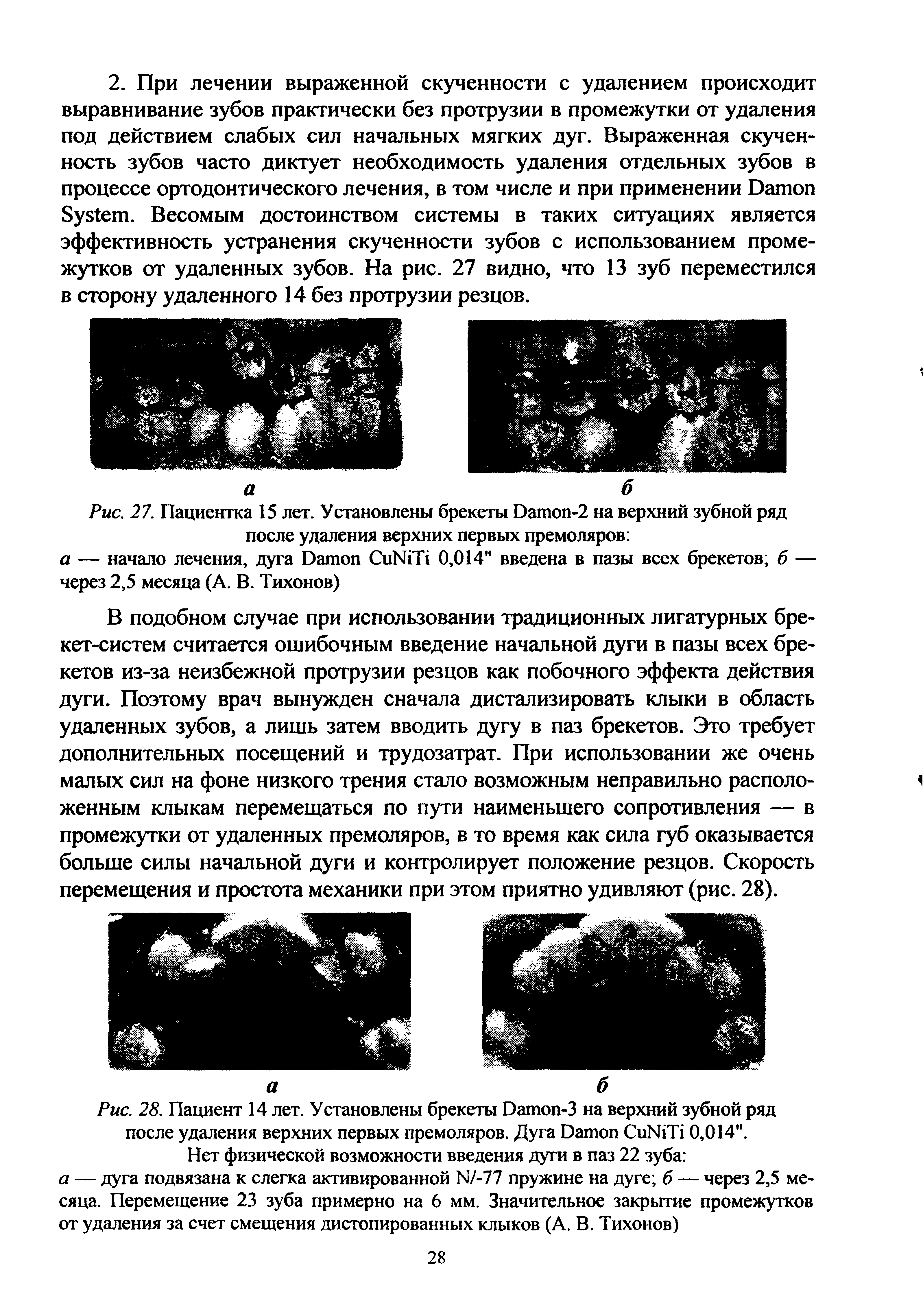 Рис. 27. Пациентка 15 лет. Установлены брекеты D -2 на верхний зубной ряд после удаления верхних первых премоляров.