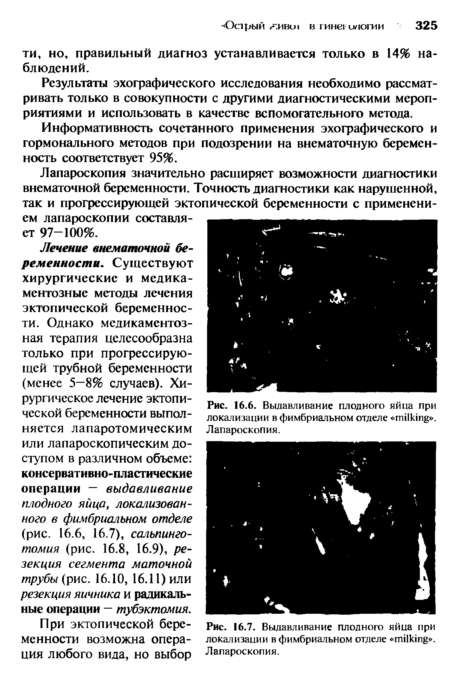 Рис. 16.6. Выдавливание плодного яйца при локализации в фимбриальном отделе . Лапароскопия.