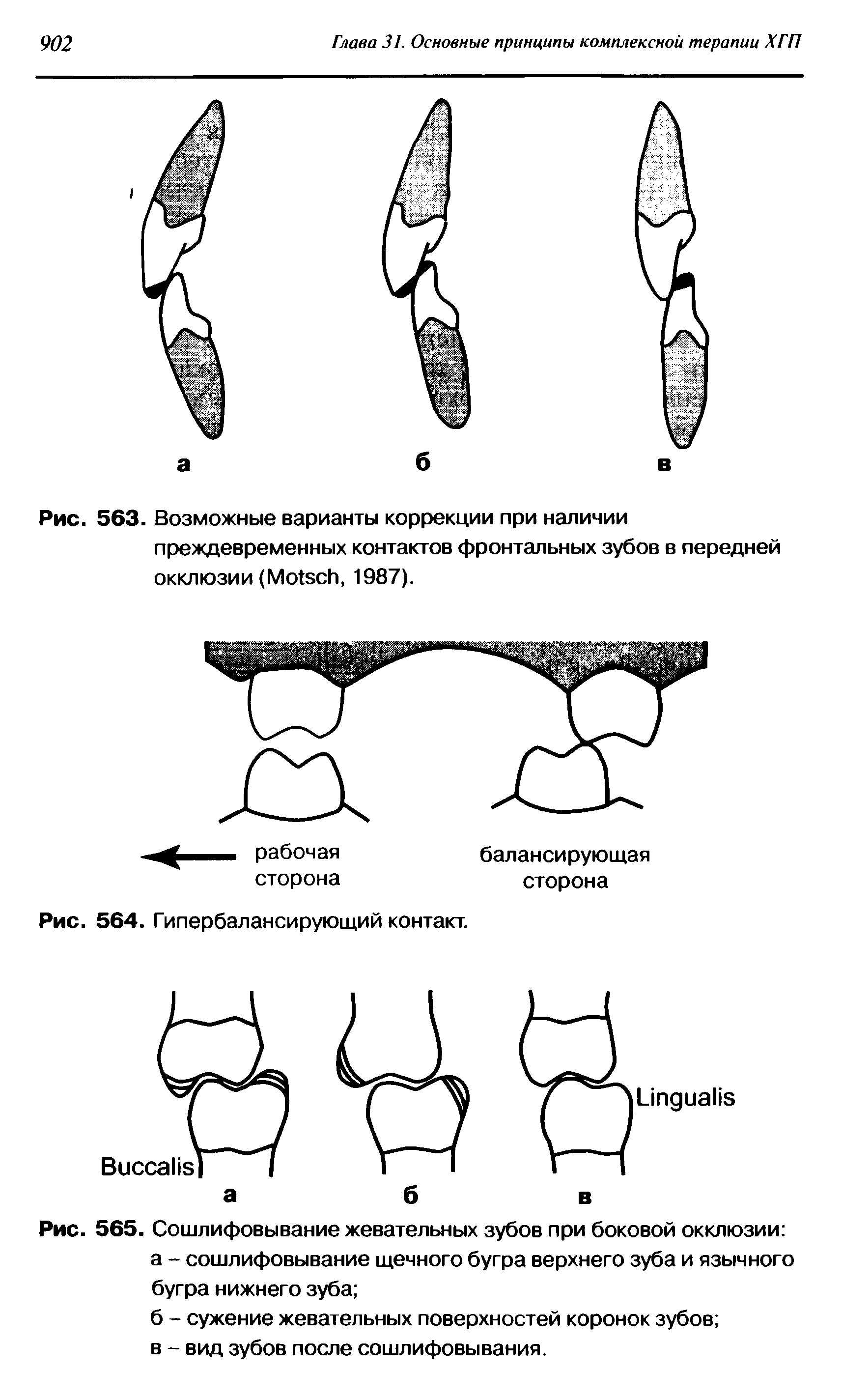 Рис. 565. Сошлифовывание жевательных зубов при боковой окклюзии а - сошлифовывание щечного бугра верхнего зуба и язычного бугра нижнего зуба ...