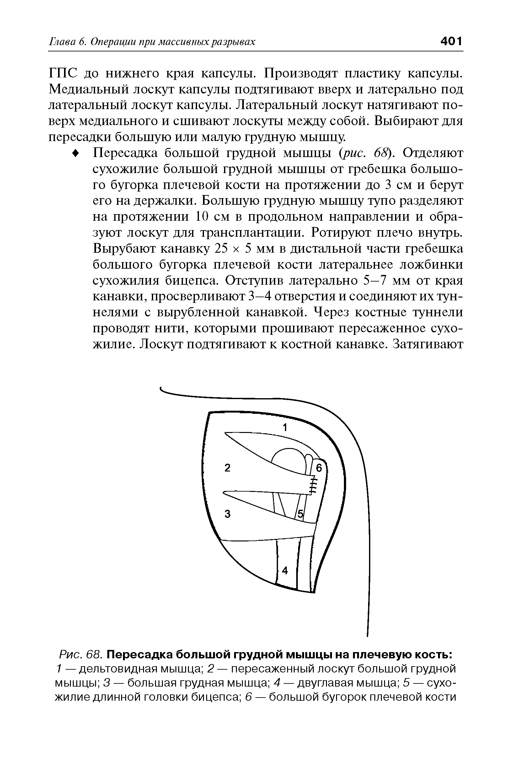 Рис. 68. Пересадка большой грудной мышцы на плечевую кость ...