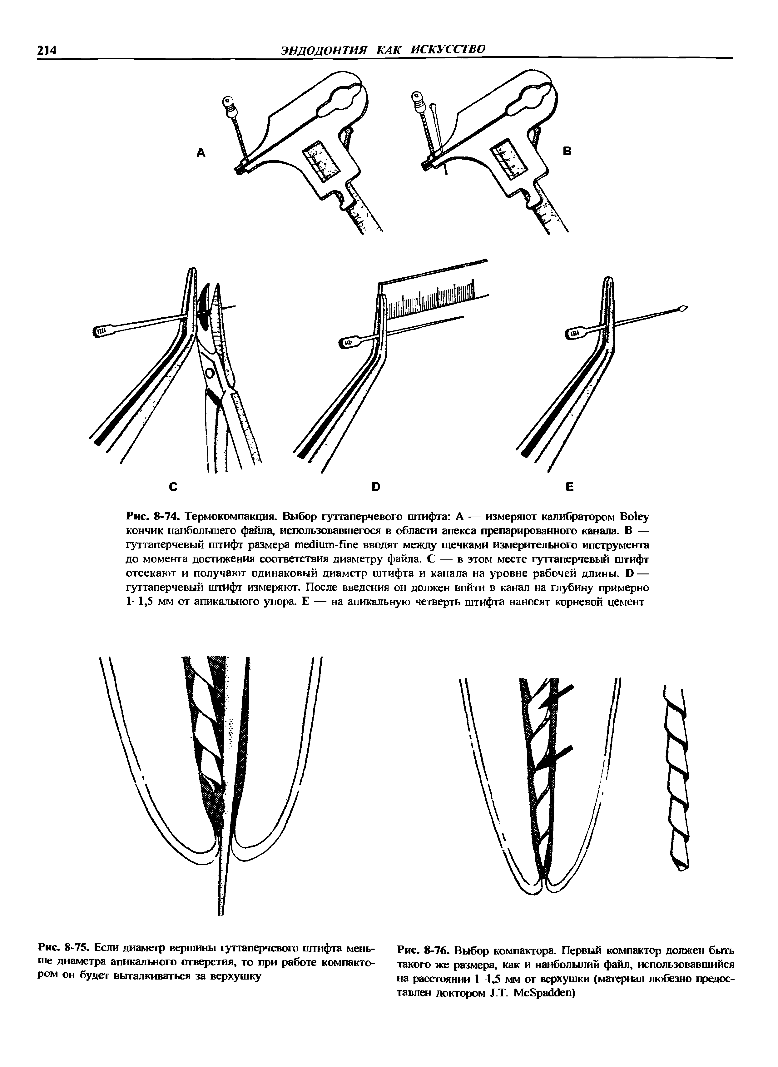 Рис. 8-76. Выбор компактора. Первый компактор должен быть такого же размера, как и наибольший файл, использовавшийся на расстоянии 1 1,5 мм от верхушки (материал любезно предоставлен доктором Л.Т. Мс8ра4беп)...