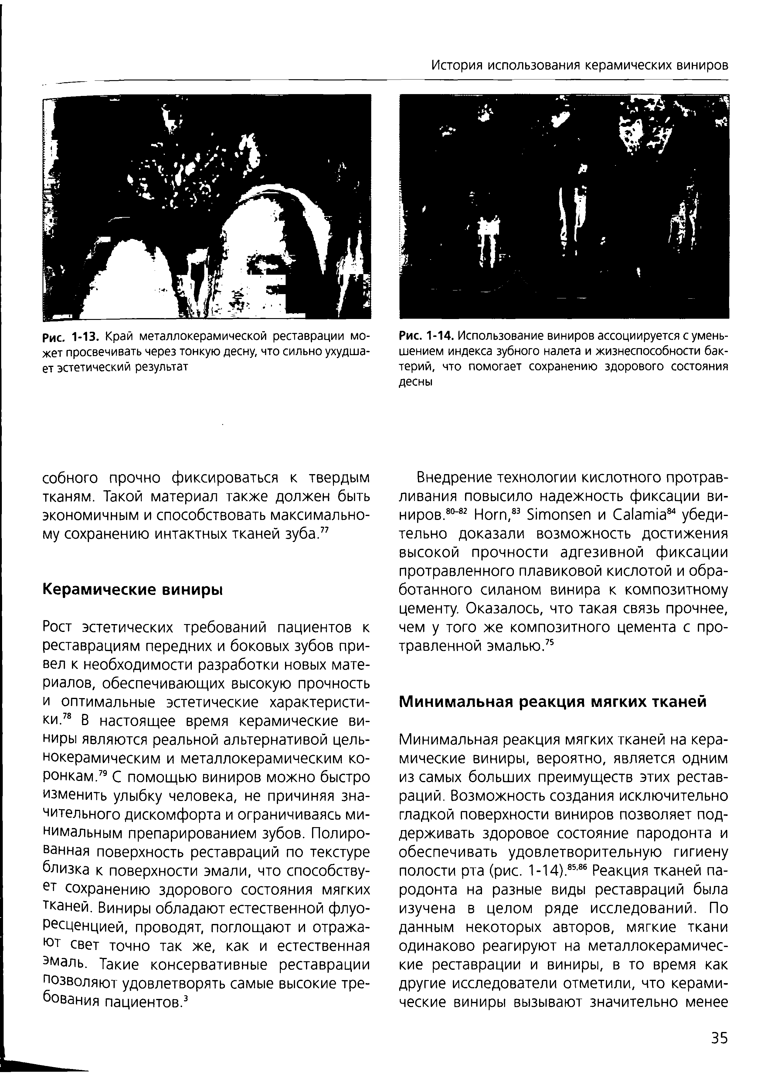 Рис. 1-13. Край металлокерамической реставрации может просвечивать через тонкую десну, что сильно ухудшает эстетический результат...