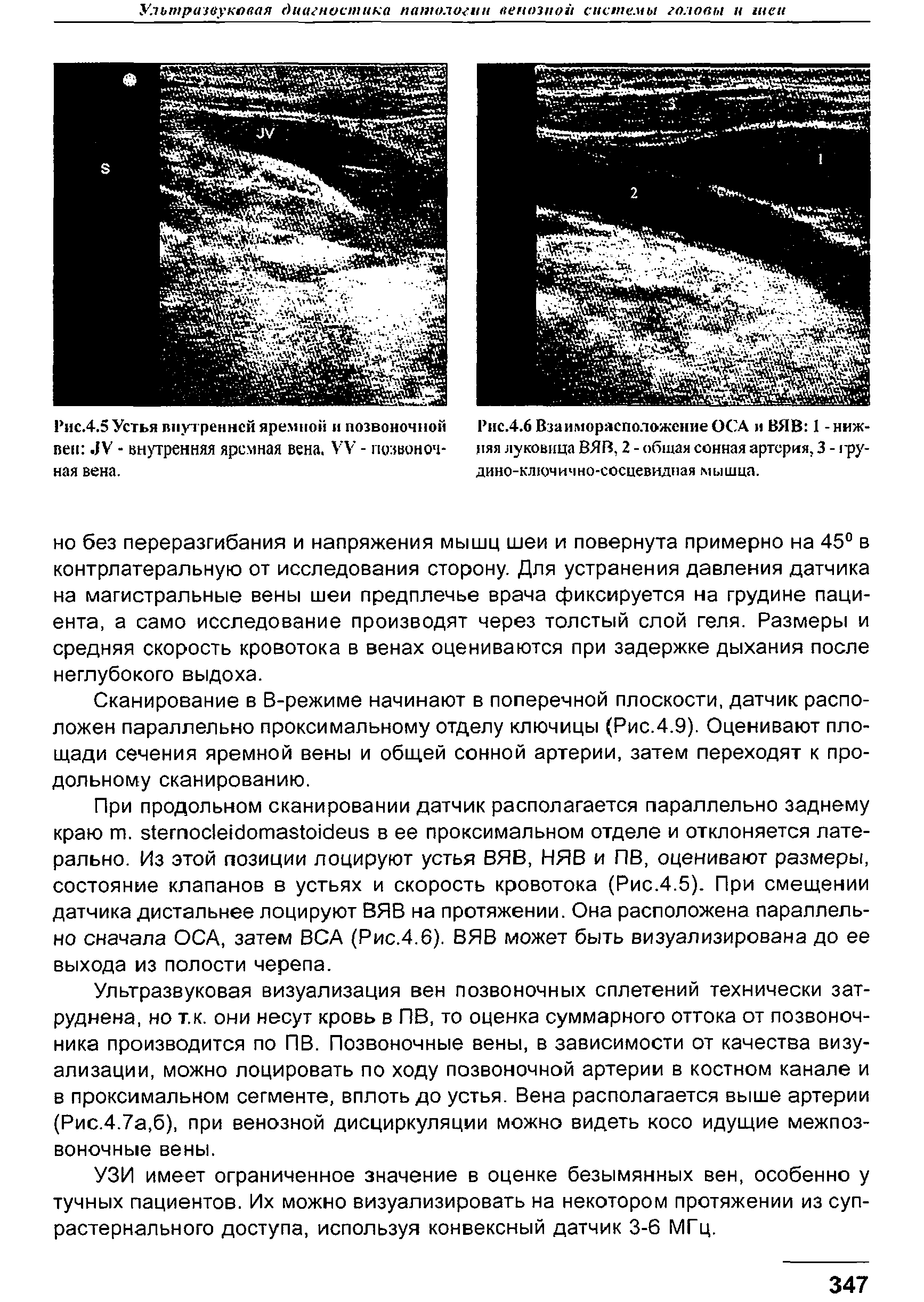 Рис.4.6 Взаиморасположение ОСА н ВЯВ 1 - нижняя луковица ВЯВ, 2 - общая сонная артерия, 3 - ру-дино-ключично-сосцевидная мыища.