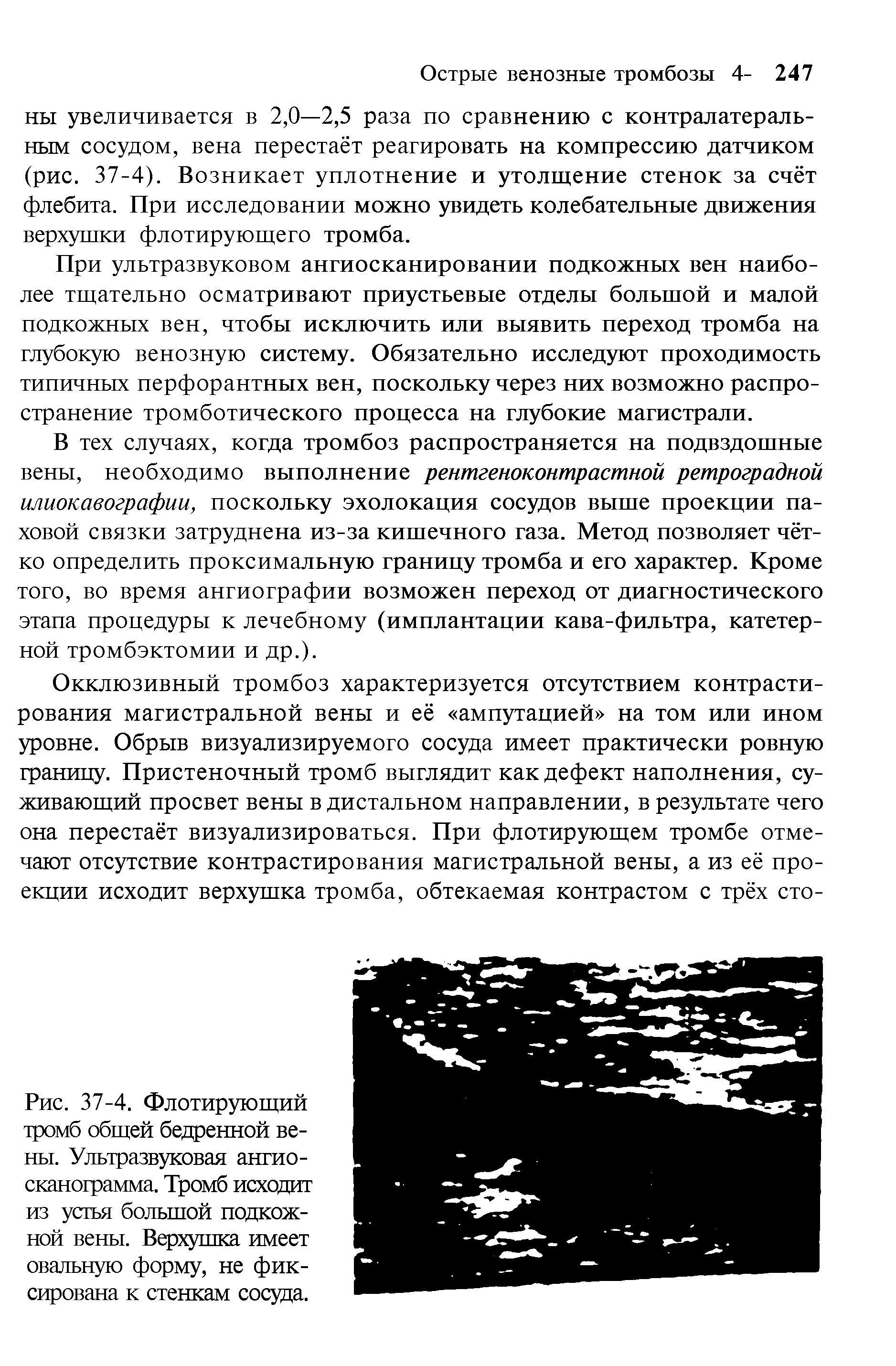 Рис. 37-4. Флотирующий тромб общей бедренной вены. Ультразвуковая ангио-сканограмма. Тромб исходит из устья большой подкожной вены. Верхушка имеет овальную форму, не фиксирована к стенкам сосуда.