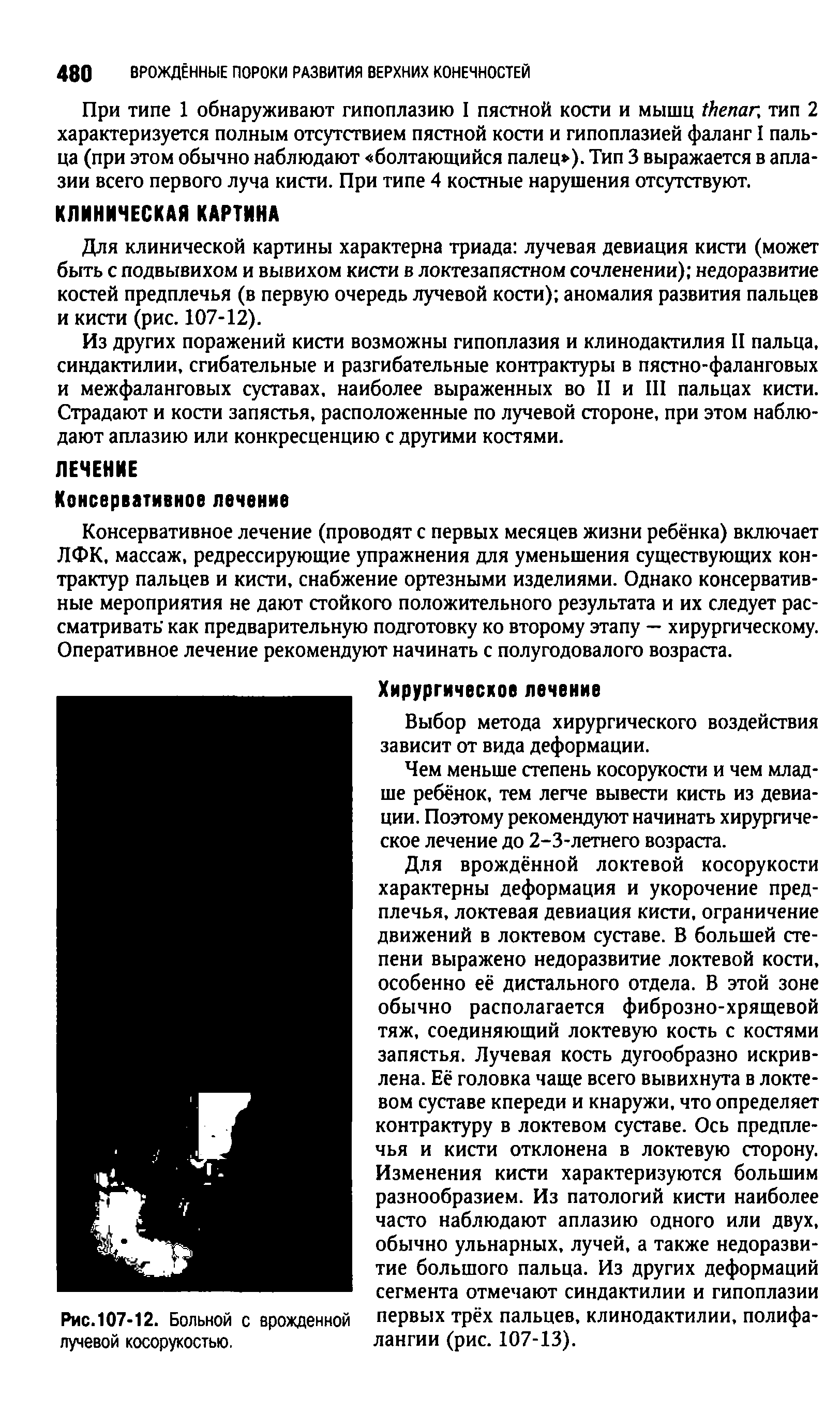 Рис.107-12. Больной с врожденной первых трёх пальцев, клинодактилии, полифа-лучевой косорукостью. лангии (рис. 107-13).