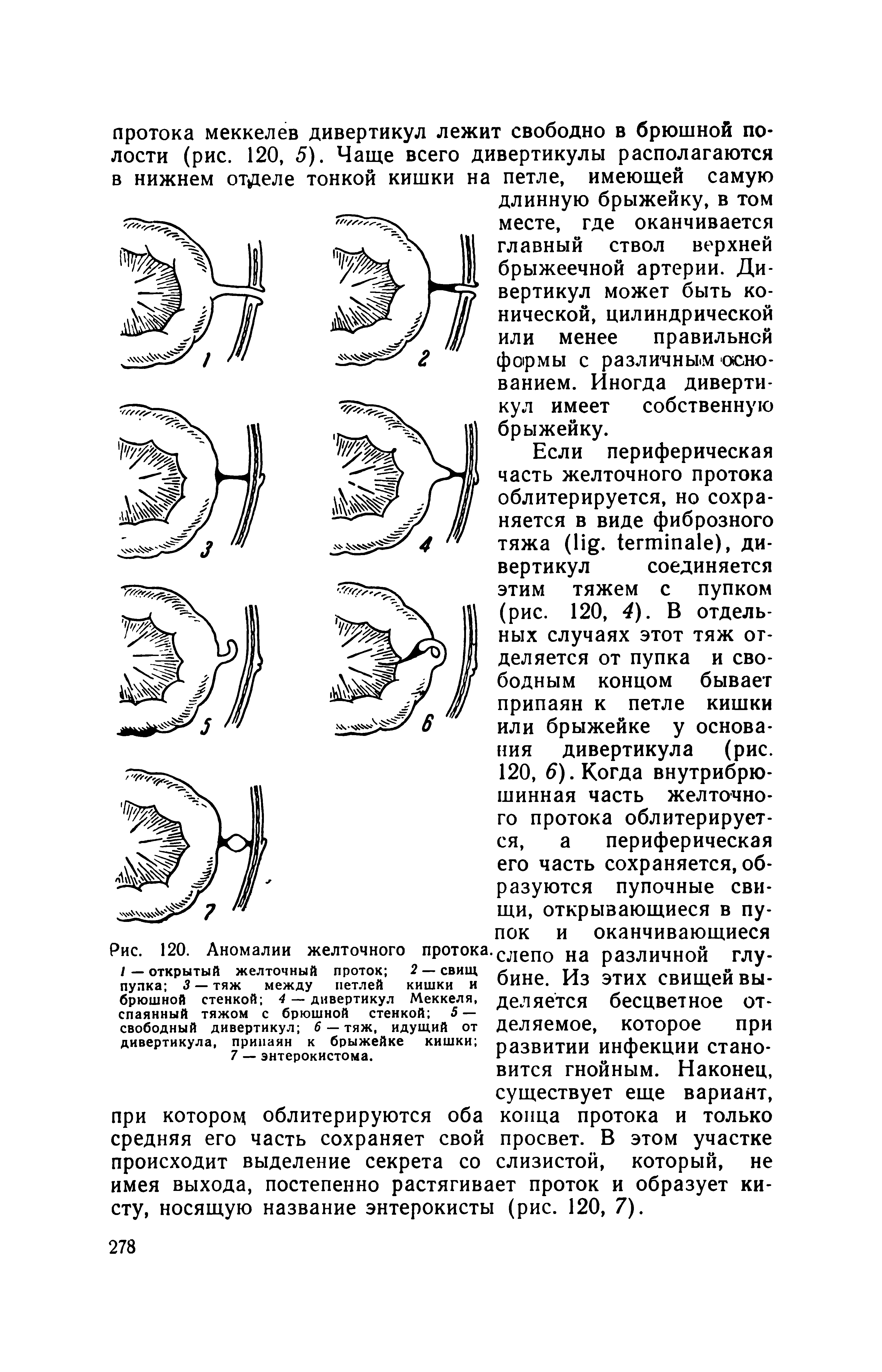 Рис. 120. Аномалии желточного протока. I — открытый желточный проток 2 — свищ пупка 3 — тяж между петлей кишки и брюшной стенкой 4 — дивертикул Меккеля, спаянный тяжом с брюшной стенкой 5 — свободный дивертикул 6 — тяж, идущий от дивертикула, припаян к брыжейке кишки ...