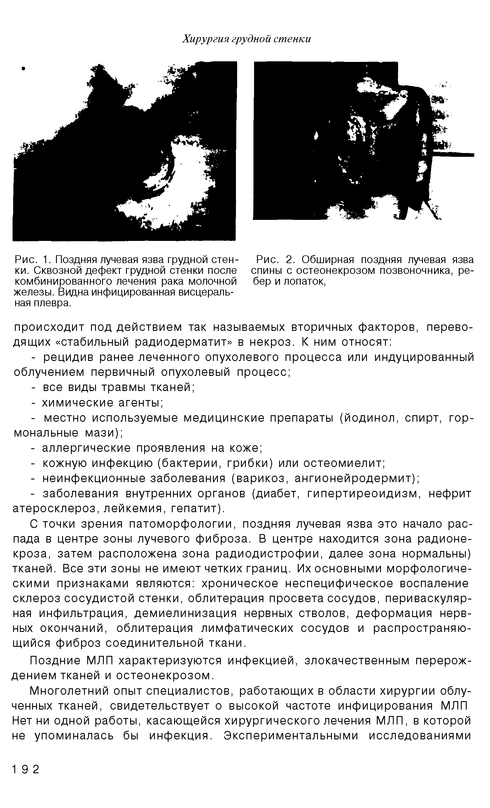 Рис. 1. Поздняя лучевая язва грудной стенки. Сквозной дефект грудной стенки после комбинированного лечения рака молочной железы. Видна инфицированная висцеральная плевра.