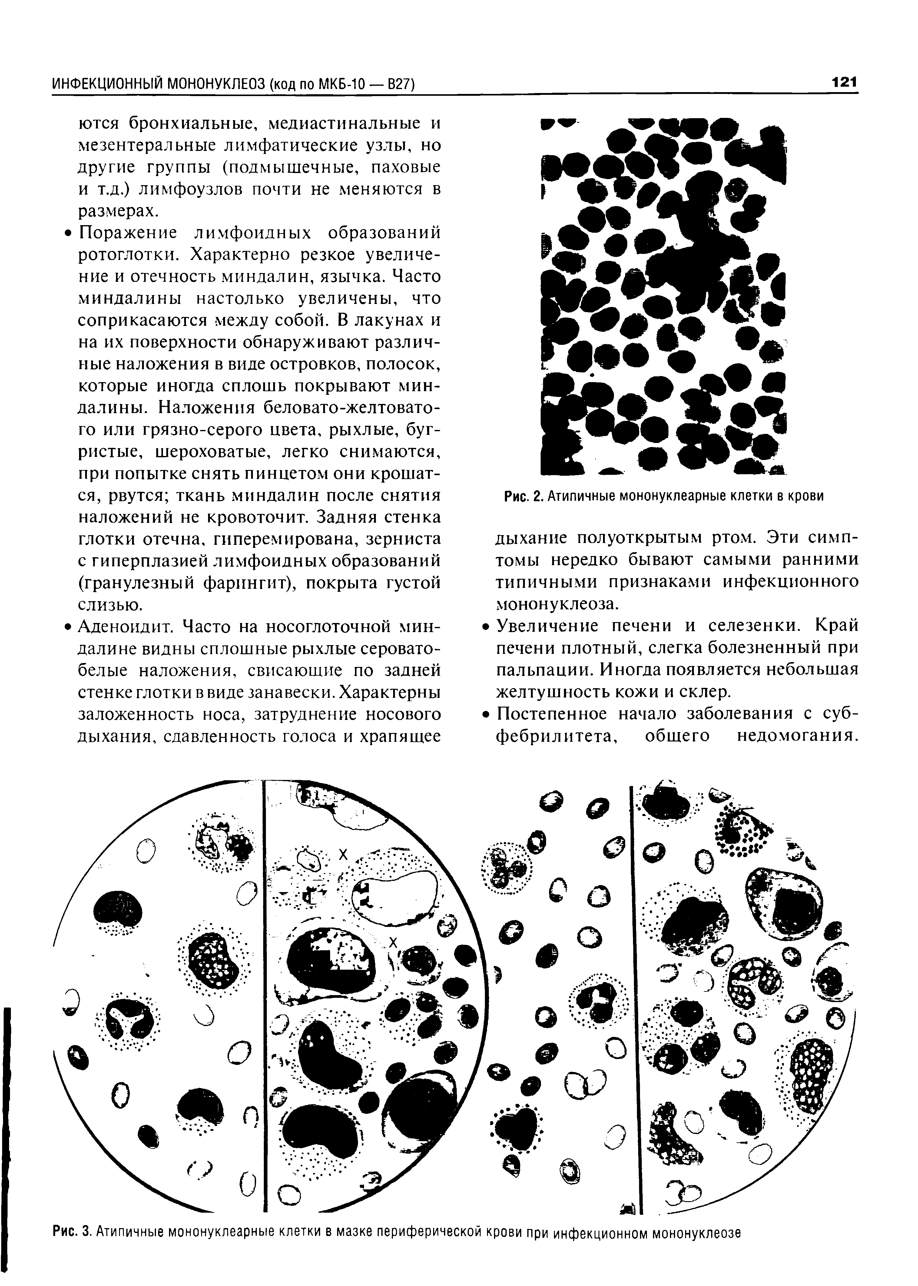 Рис. 3. Атипичные мононуклеарные клетки в мазке периферической крови при инфекционном мононуклеозе...