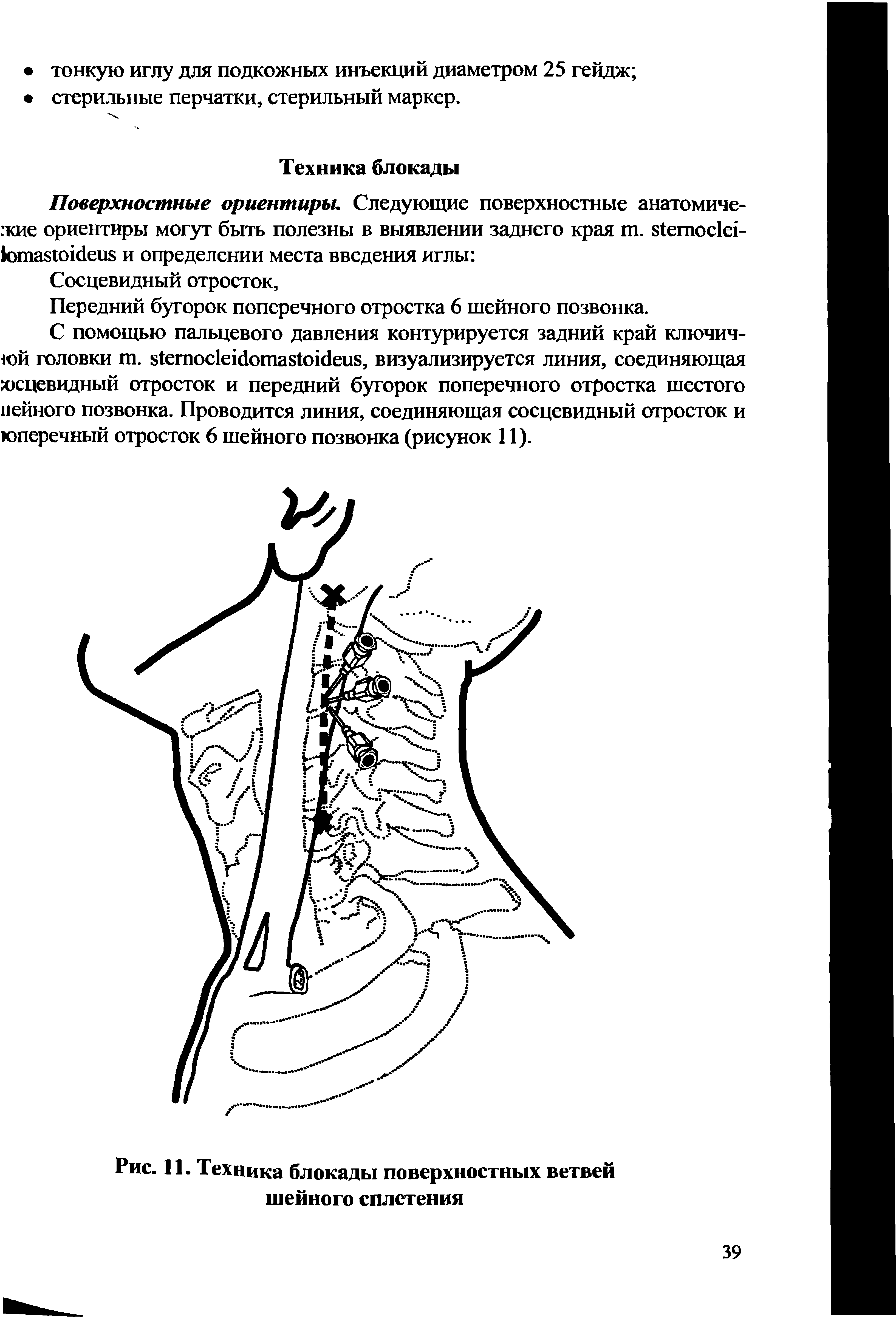 Рис. 11. Техника блокады поверхностных ветвей шейного сплетения...