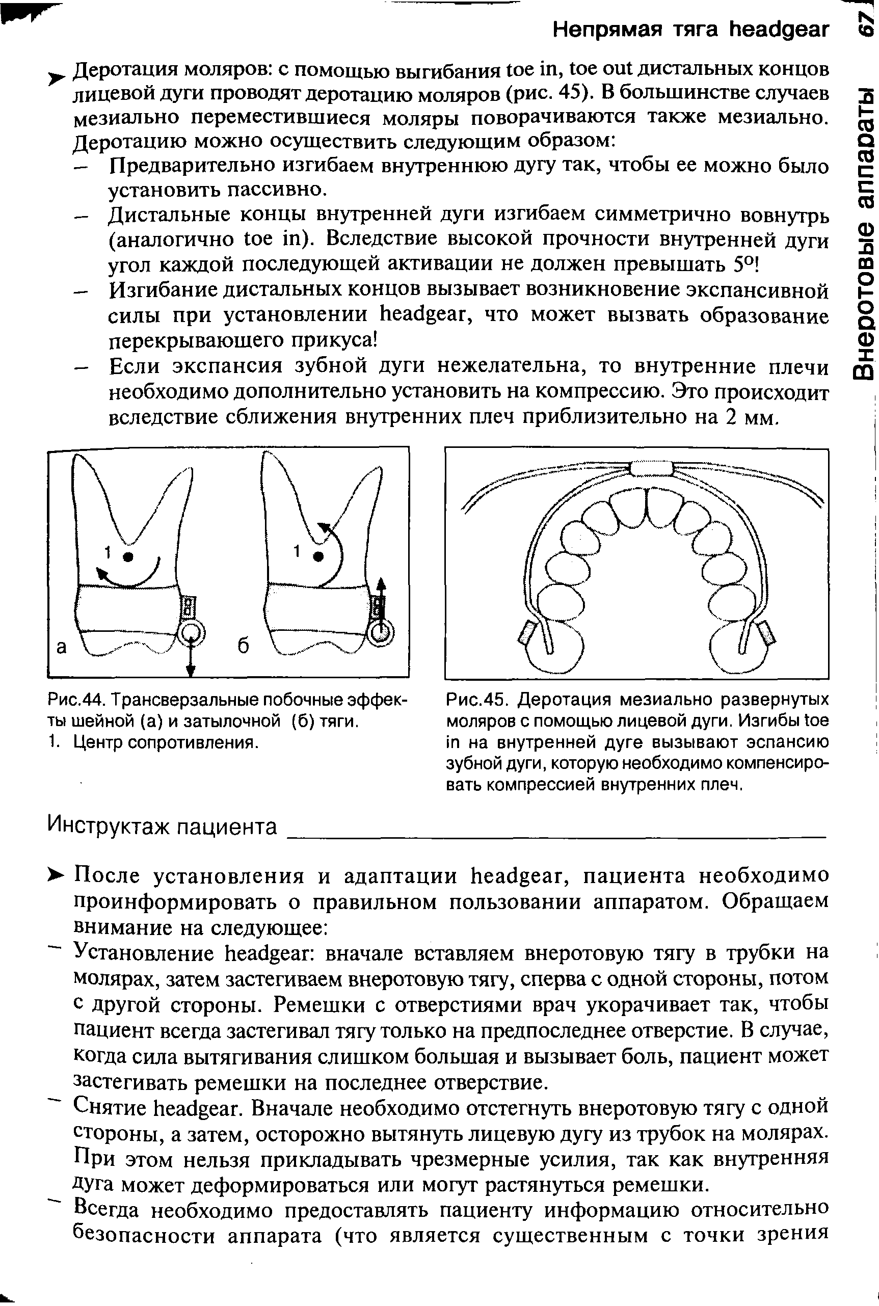 Рис.45. Деротация мезиально развернутых моляров с помощью лицевой дуги. Изгибы на внутренней дуге вызывают эспансию зубной дуги, которую необходимо компенсировать компрессией внутренних плеч.