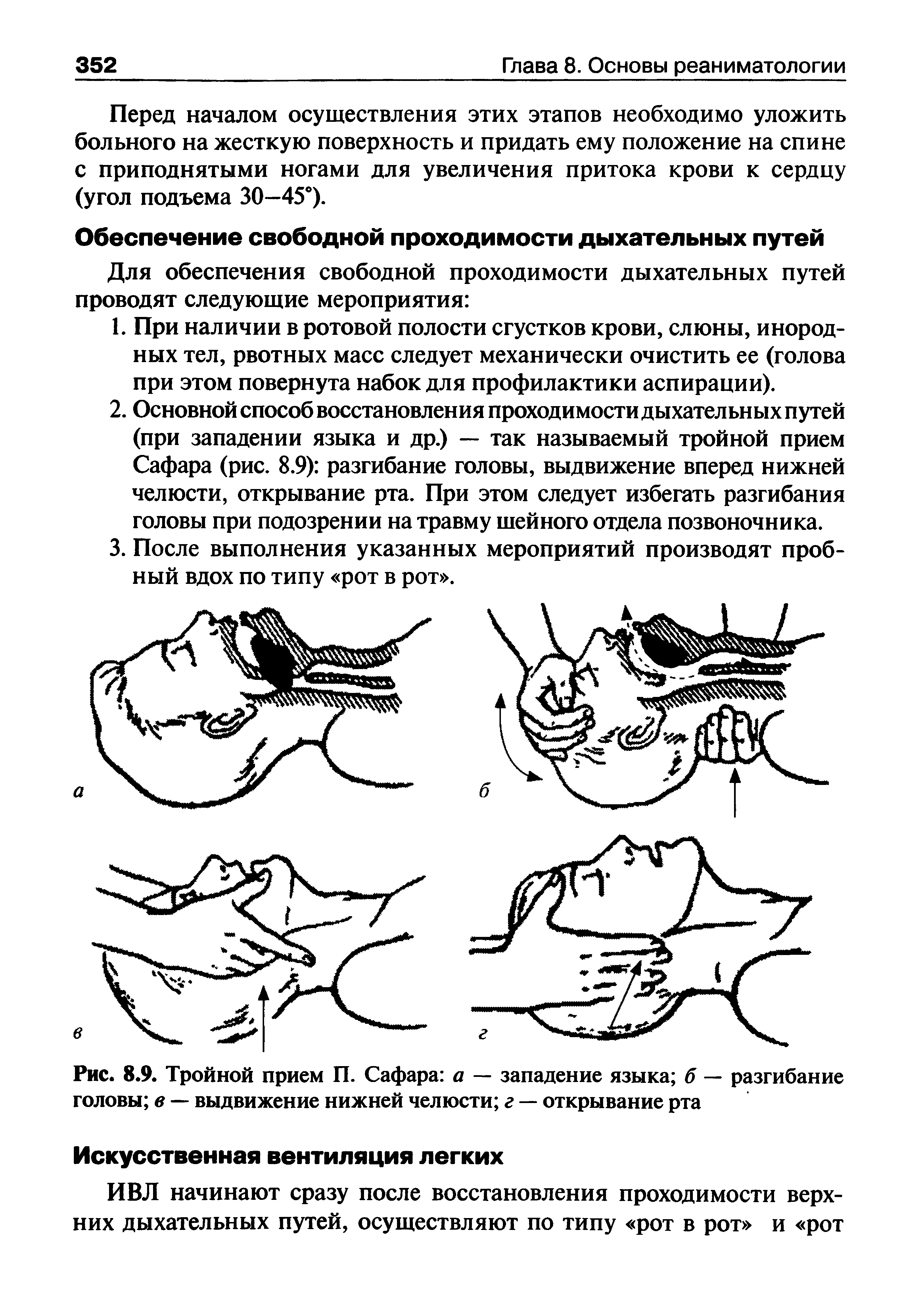 Рис. 8.9. Тройной прием П. Сафара а — западение языка б — разгибание головы в — выдвижение нижней челюсти г — открывание рта...