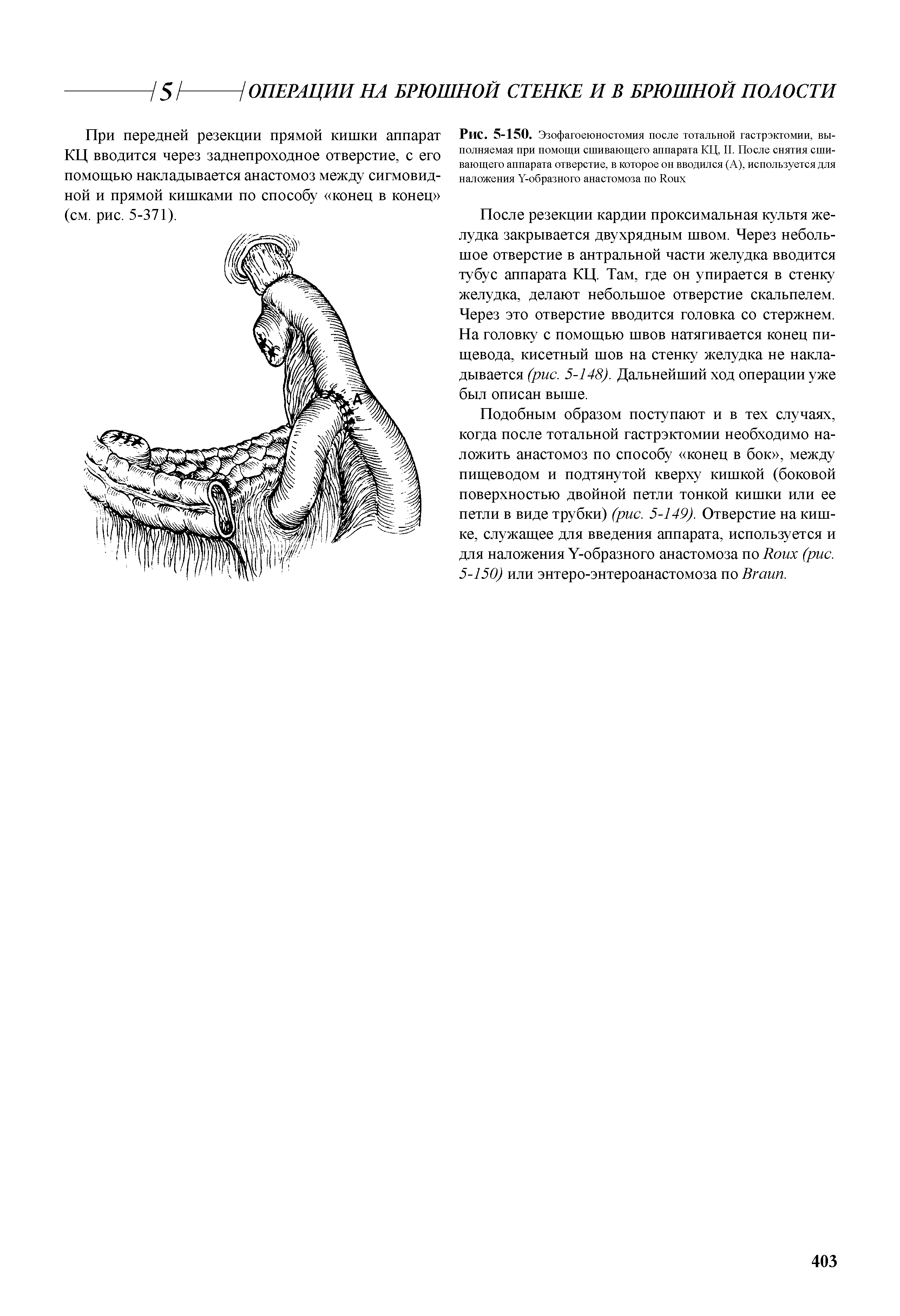 Рис. 5-150. Эзофагоеюностомия после тотальной гастрэктомии, выполняемая при помощи сшивающего аппарата КЦ, II. После снятия сшивающего аппарата отверстие, в которое он вводился (А), используется для наложения Y-образного анастомоза по R ...
