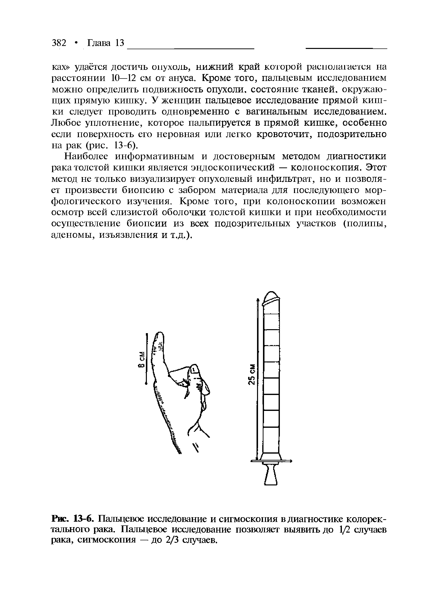 Рис. 13-6. Пальцевое исследование и сигмоскопия в диагностике колоректального рака. Пальцевое исследование позволяет выявить до 1/2 случаев рака, сигмоскопия — до 2/3 случаев.