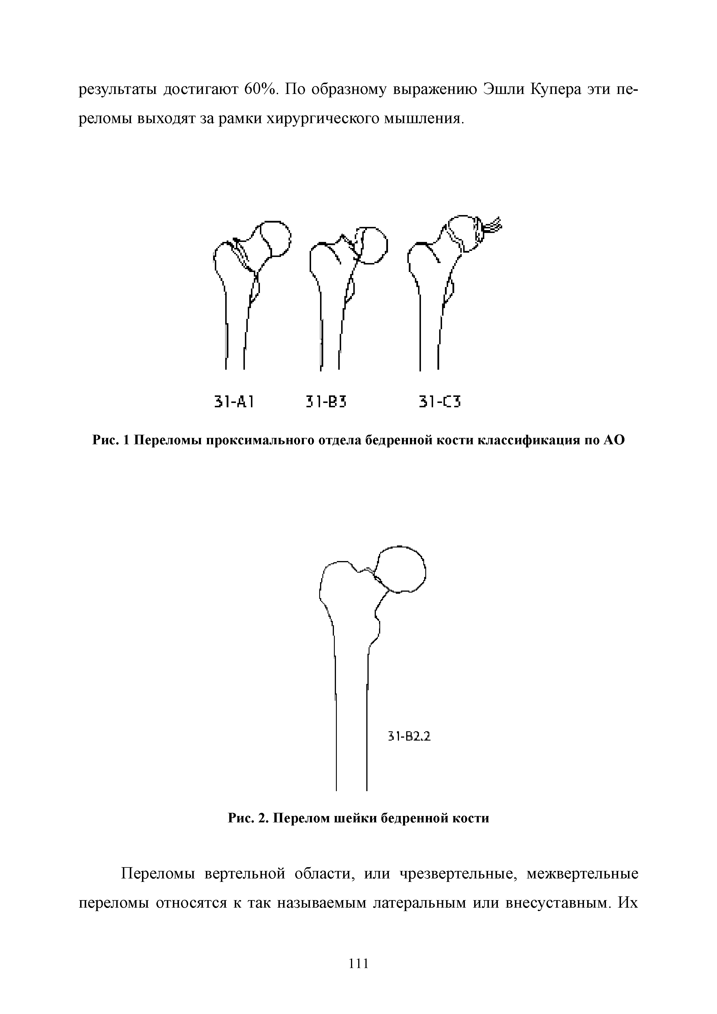 Рис. 1 Переломы проксимального отдела бедренной кости классификация по АО...
