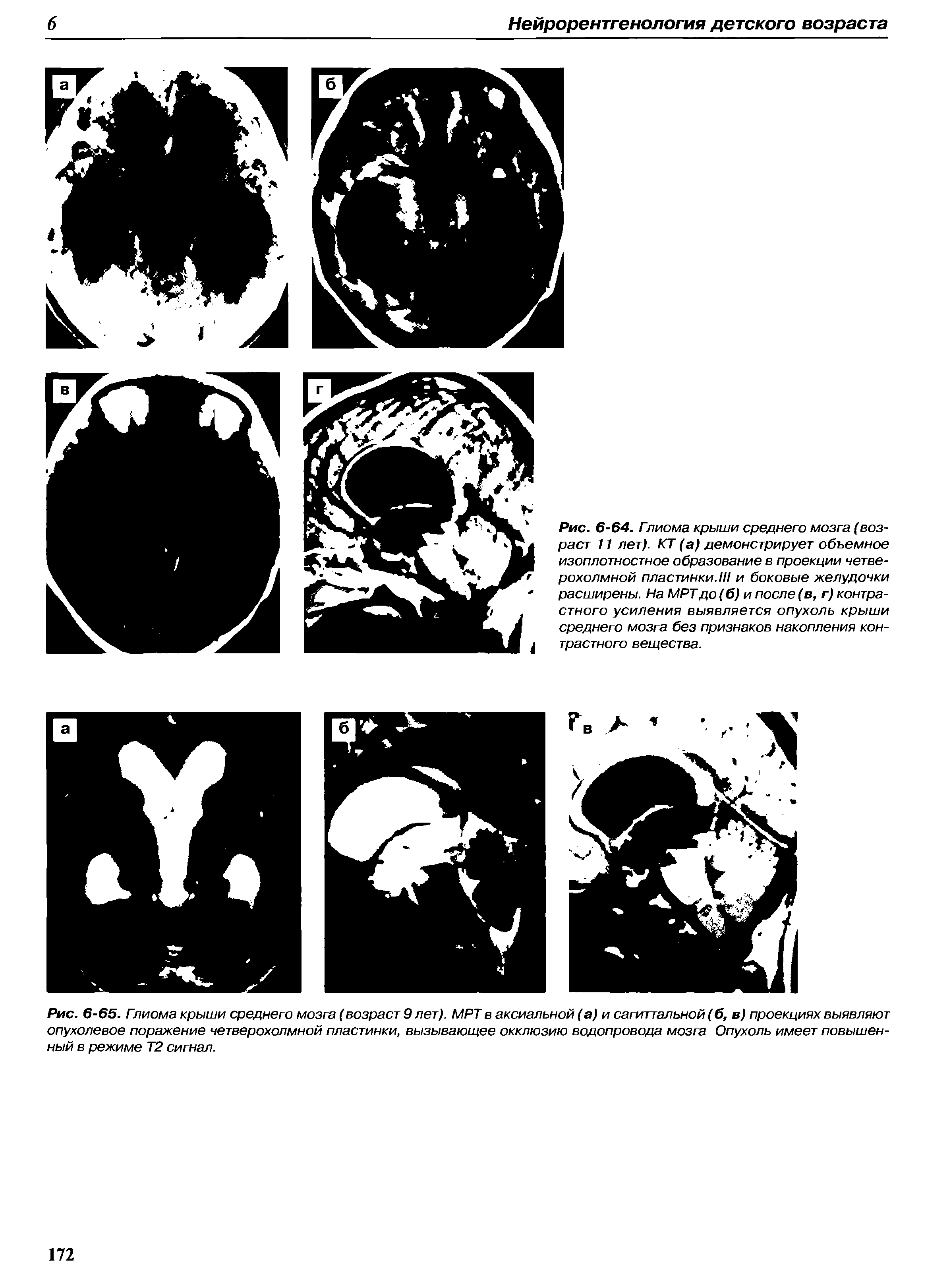 Рис. 6-65. Гпиома крыши среднего мозга (возраст 9 лет). МРТ в аксиальной (а) и сагиттальной (б, в) проекциях выявляют опухолевое поражение четверохолмной пластинки, вызывающее окклюзию водопровода мозга Опухоль имеет повышенный в режиме Т2 сигнал.