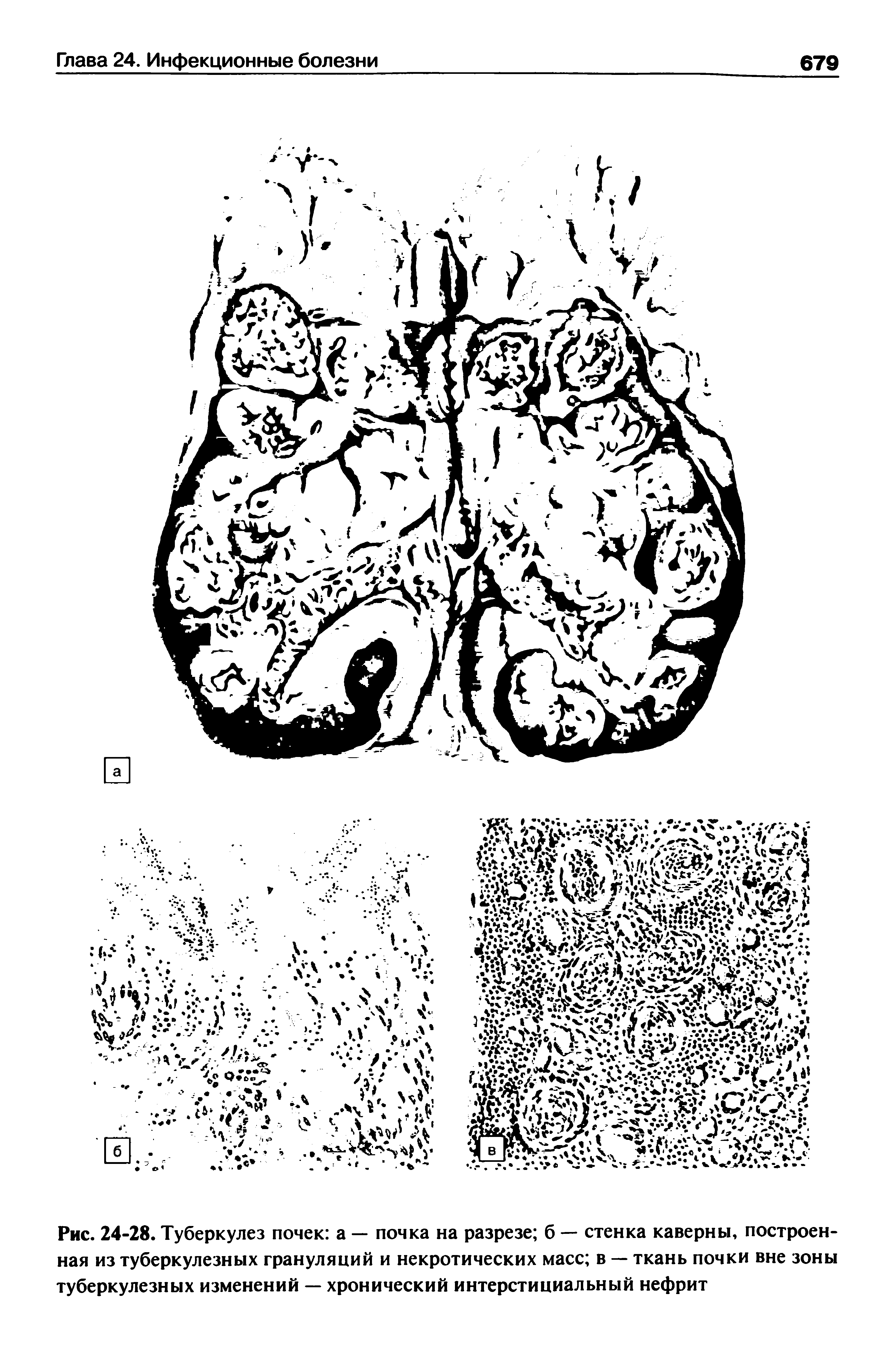 Рис. 24-28. Туберкулез почек а — почка на разрезе б — стенка каверны, построенная из туберкулезных грануляций и некротических масс в — ткань почки вне зоны туберкулезных изменений — хронический интерстициальный нефрит...