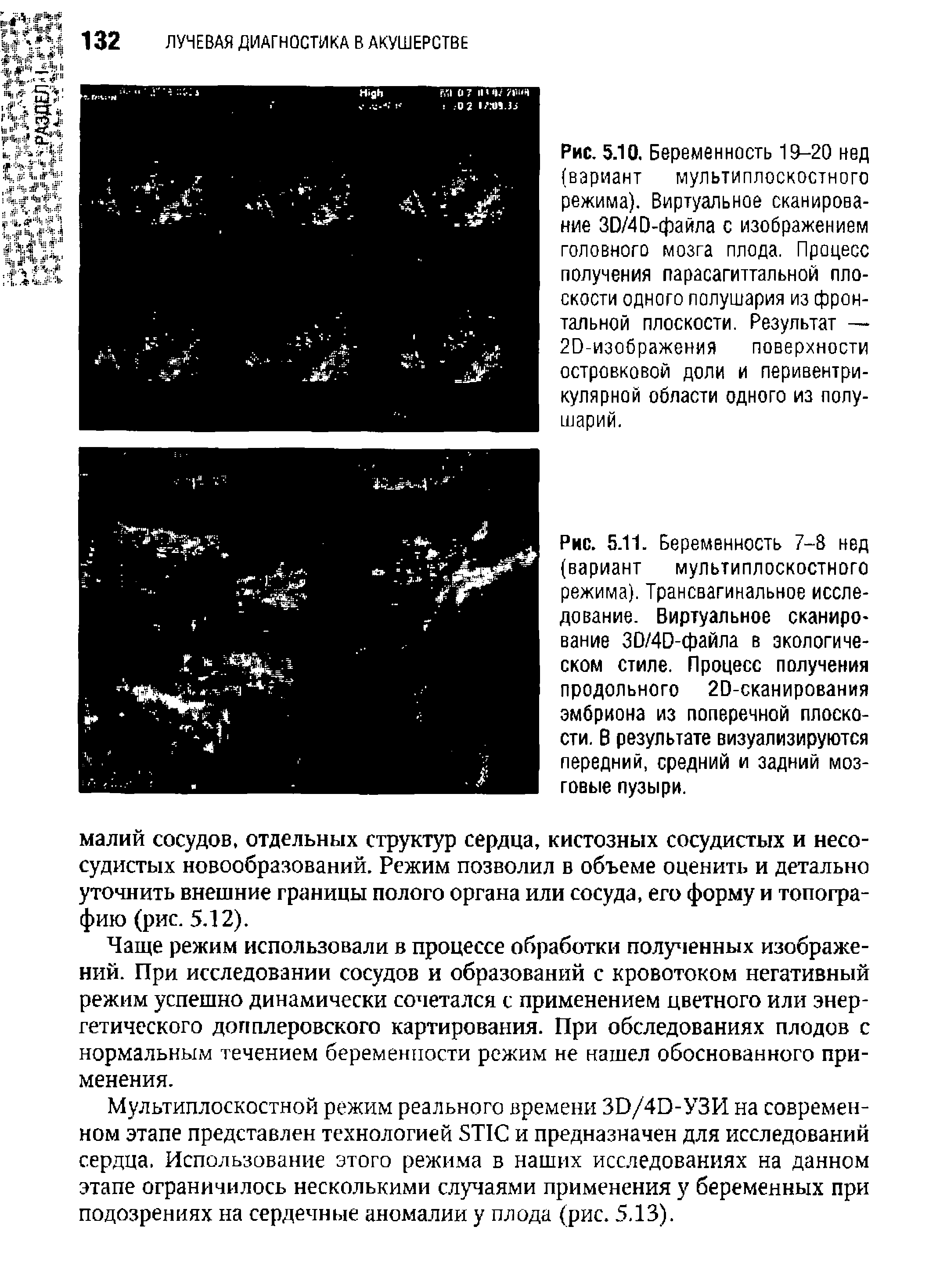 Рис. 5.11. Беременность 7-8 нед (вариант мультиплоскостного режима). Трансвагинальное исследование. Виртуальное сканирование ЗО/4О-файла в экологическом стиле. Процесс получения продольного 20-сканирования эмбриона из поперечной плоскости. В результате визуализируются передний, средний и задний мозговые пузыри.