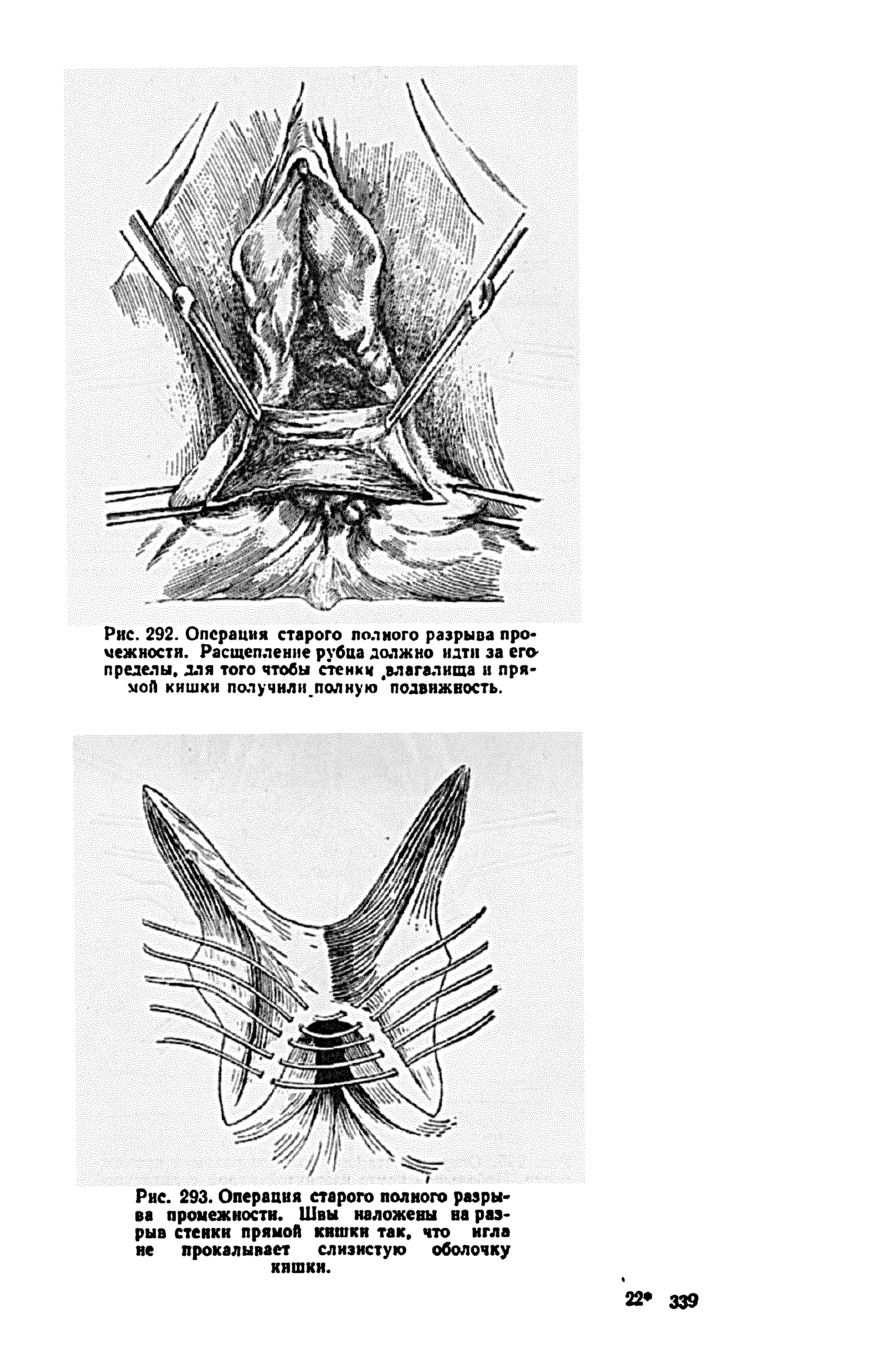 Рис. 293. Операция старого полного разрыва промежности. Швы наложены на разрыв стенки прямой кишки так, что игла не прокалывает слизистую оболочку кишки.